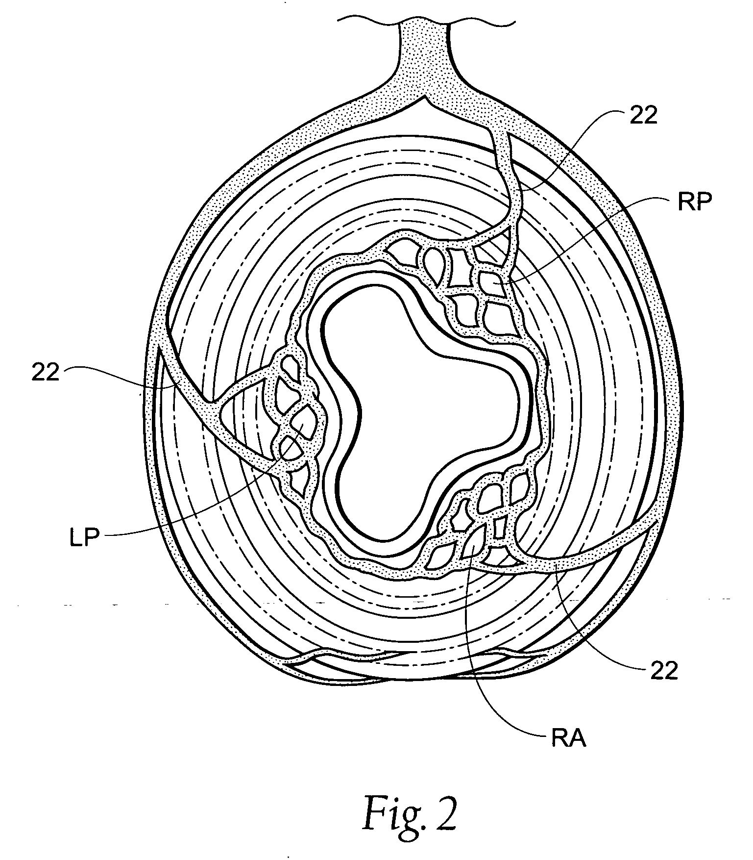 Systems and methods for treating hemorrhoids