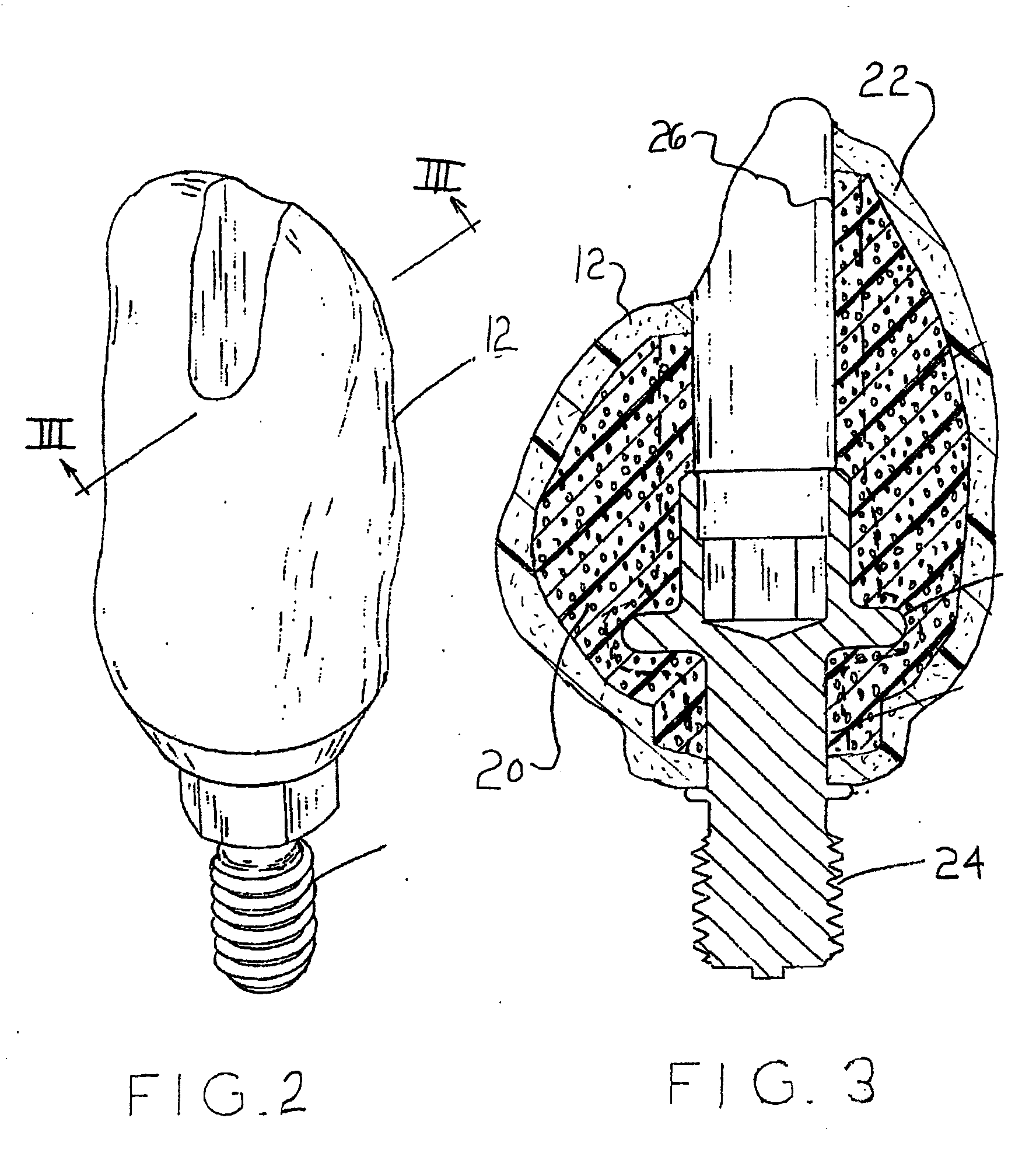 Polymer Core Prosthetic Dental Device with an Esthetic Surface