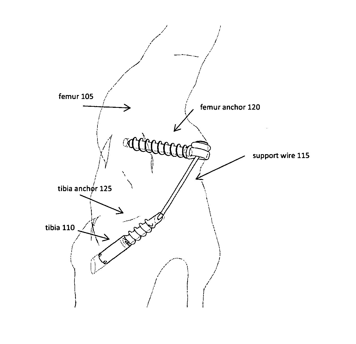 Joint stability device and method