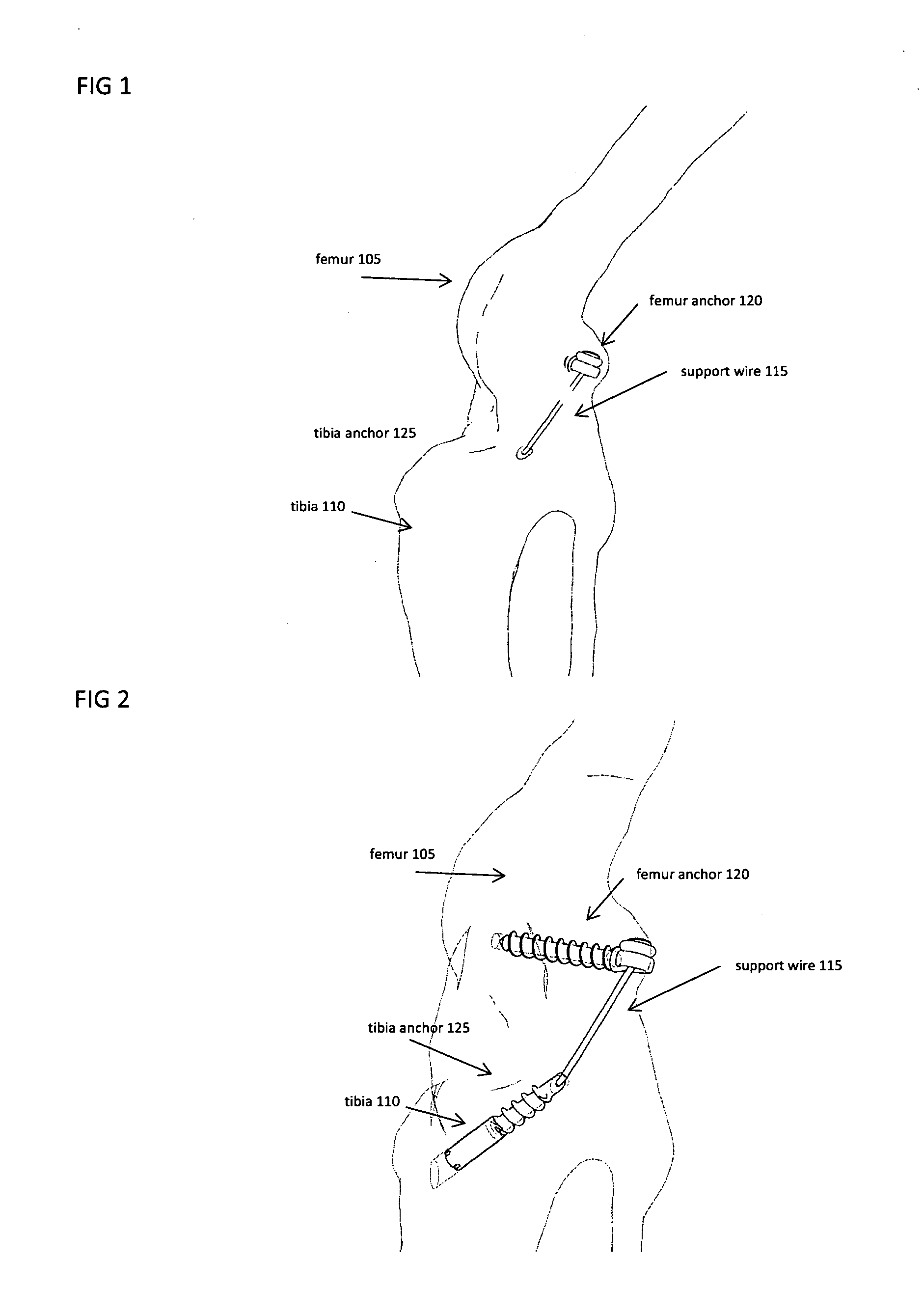 Joint stability device and method