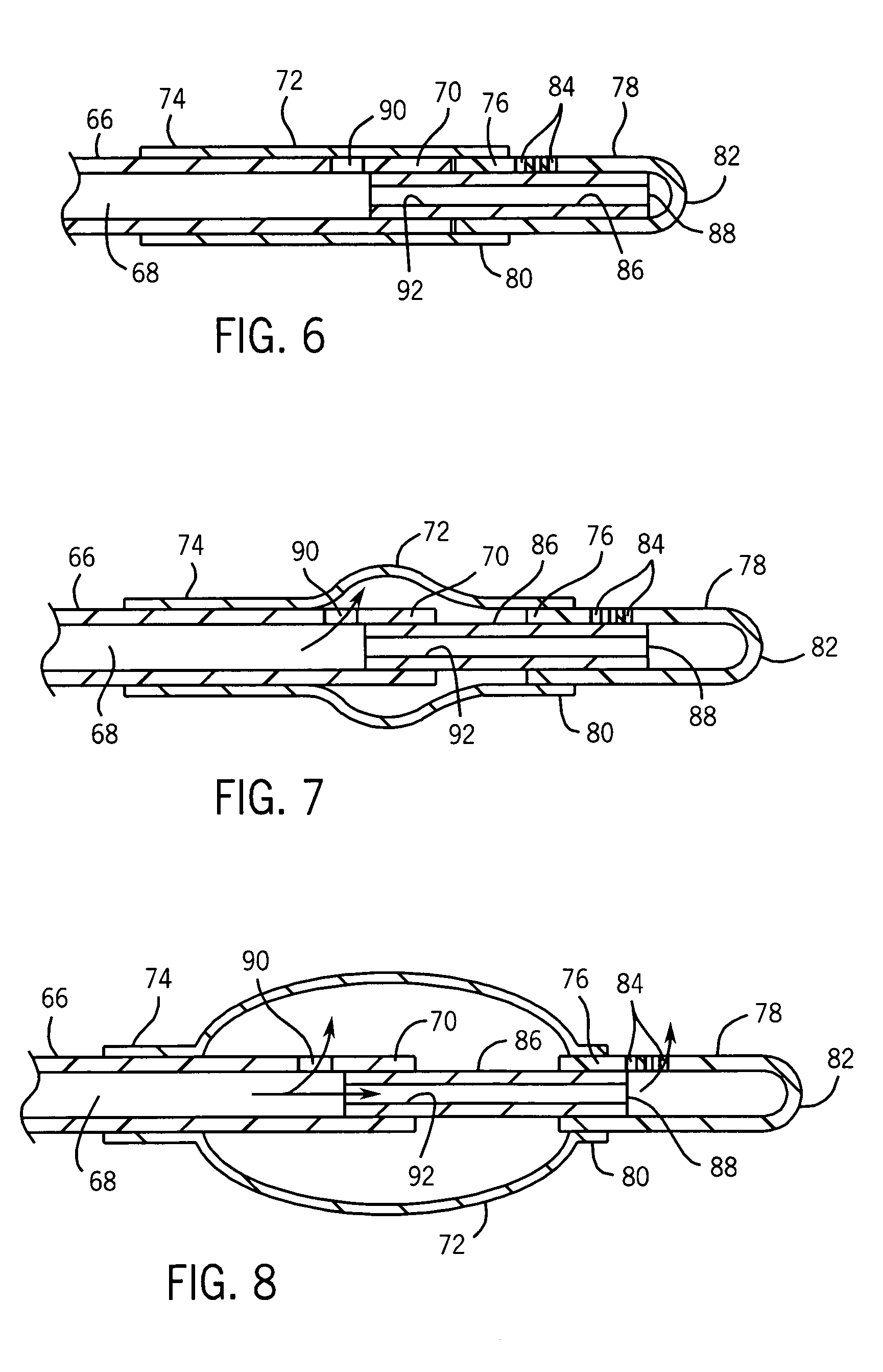 Catheter with autoinflating, autoregulating balloon