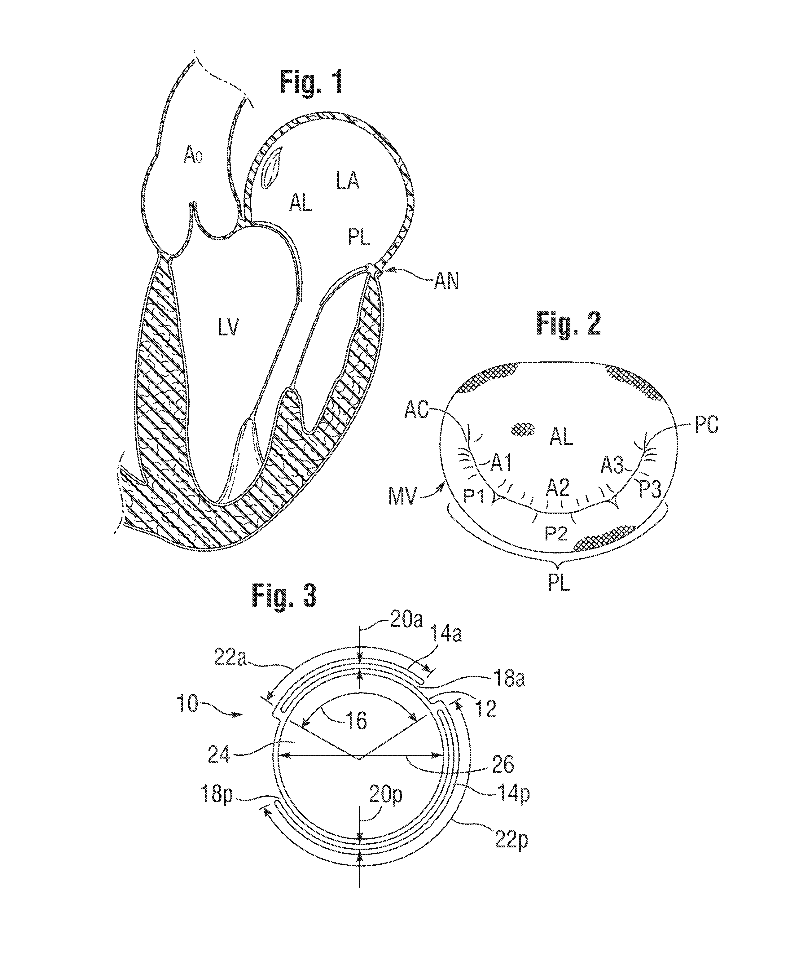 Anchoring device for replacing or repairing a heart valve