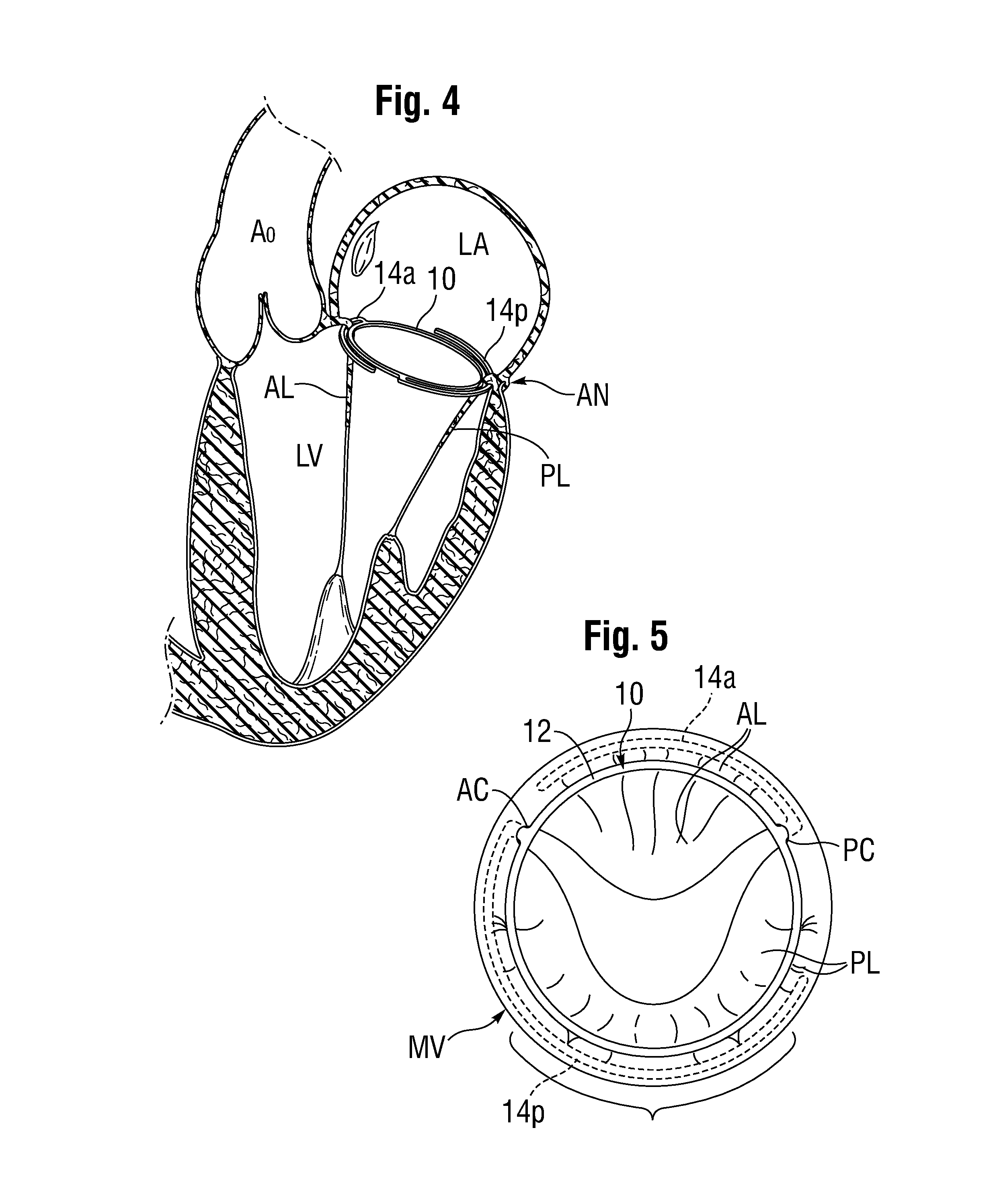 Anchoring device for replacing or repairing a heart valve