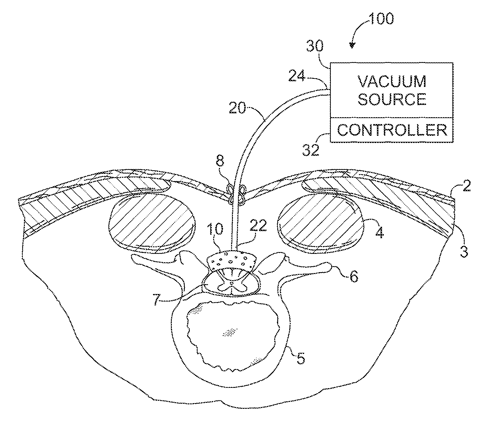 Devices and methods for treating spinal cord tissue