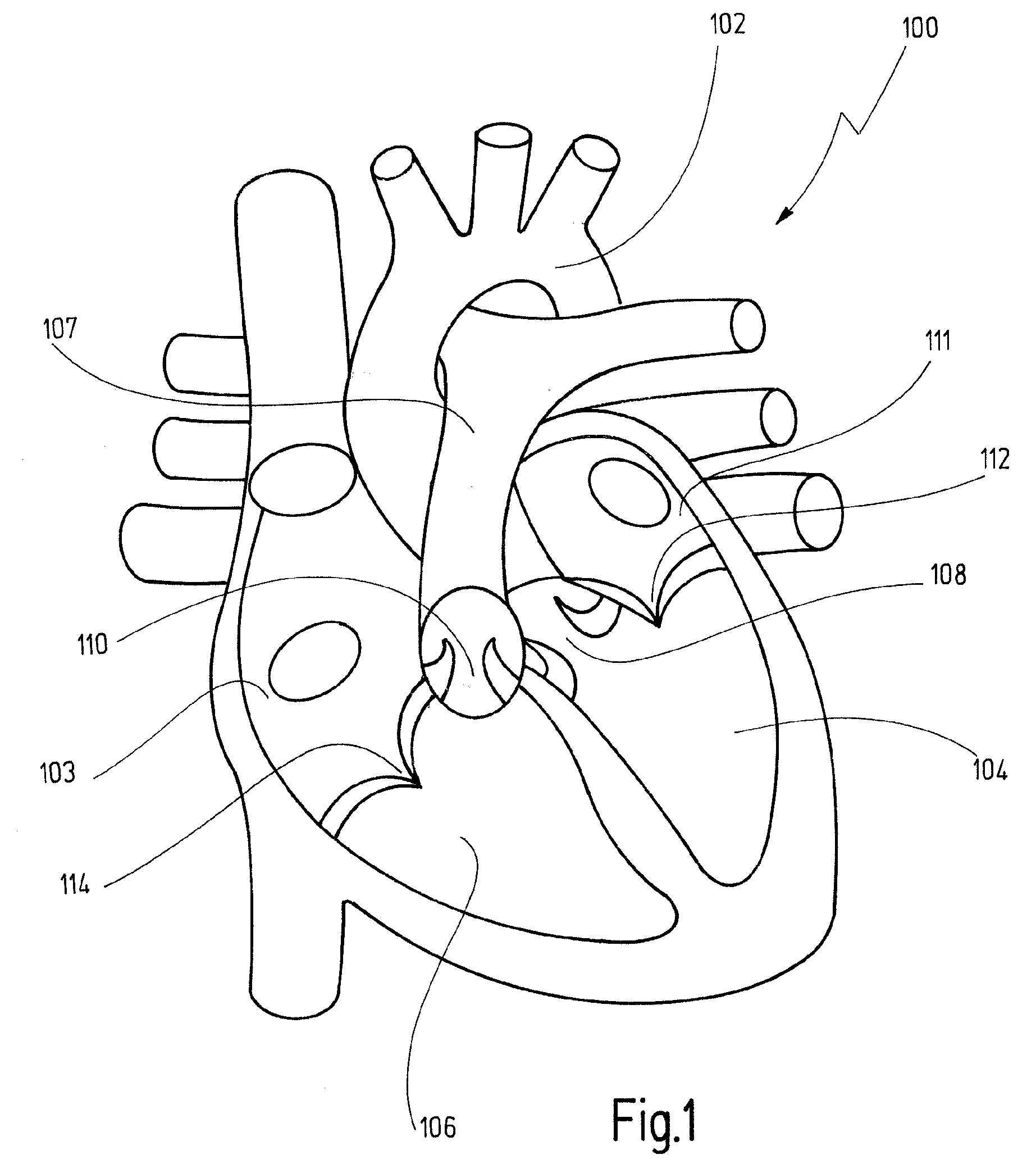 Cardiac valve prosthesis system