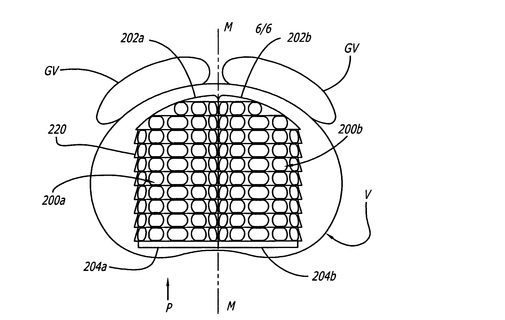 Method for installation of artificial hemi-lumbar interbody spinal fusion implant having an asymmetrical leading end