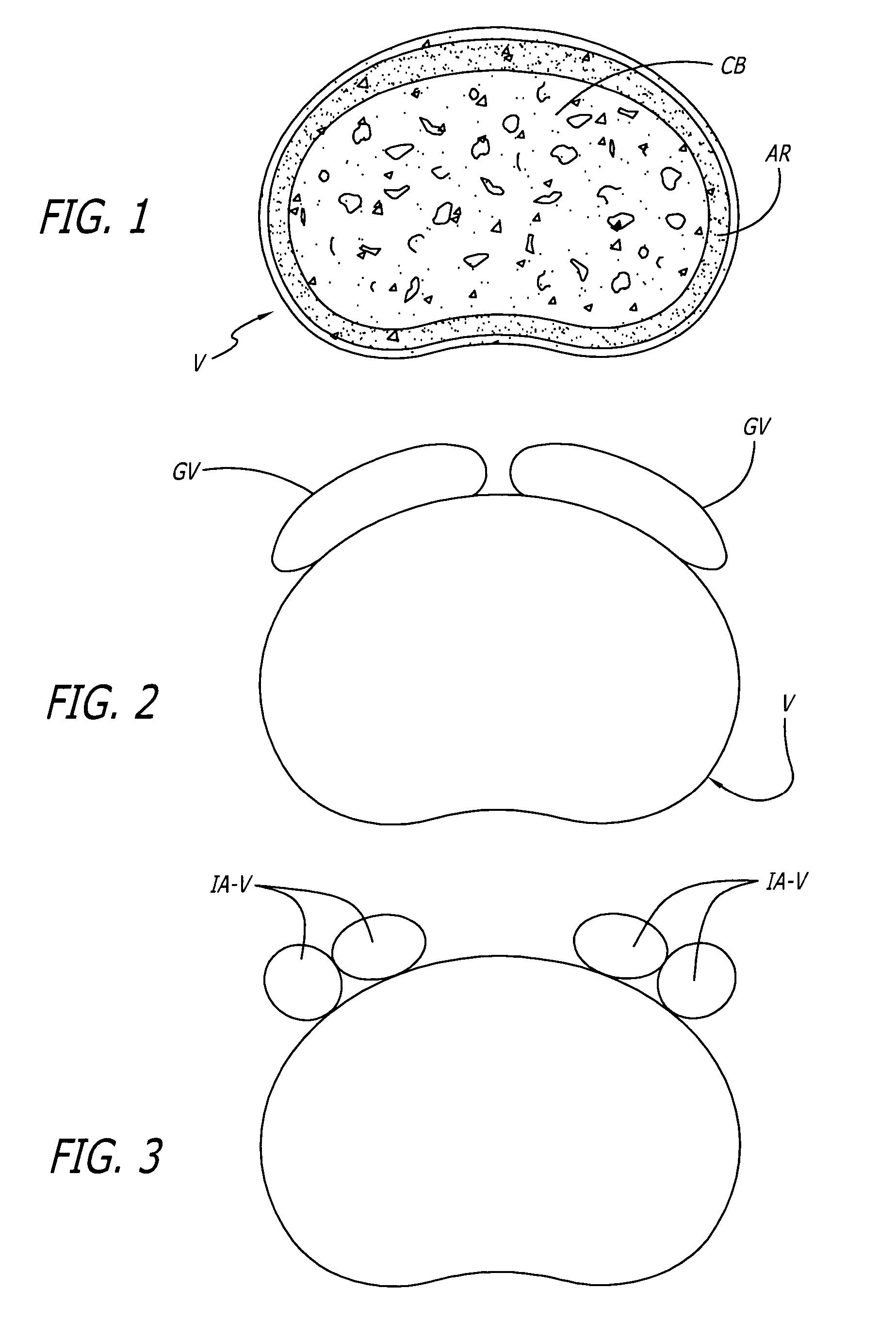 Method for installation of artificial hemi-lumbar interbody spinal fusion implant having an asymmetrical leading end