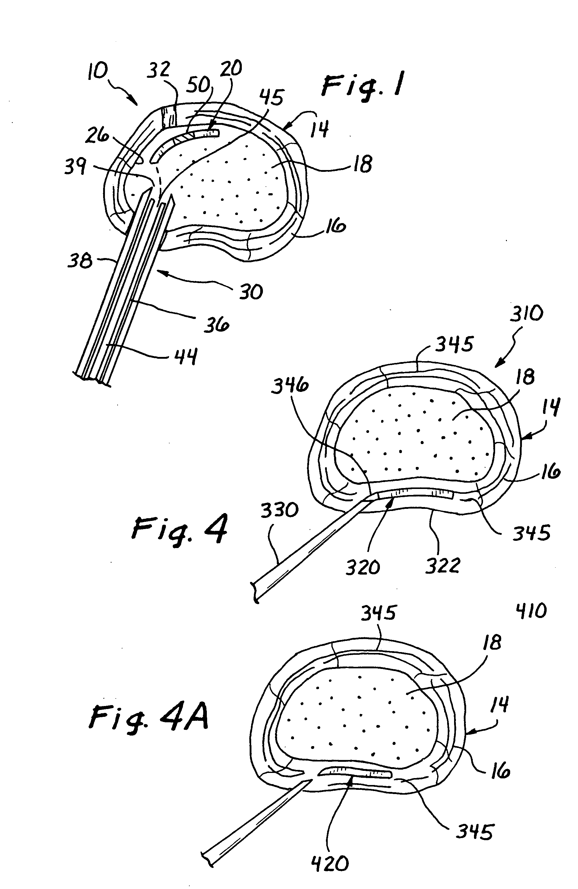 Spinal disc therapy system