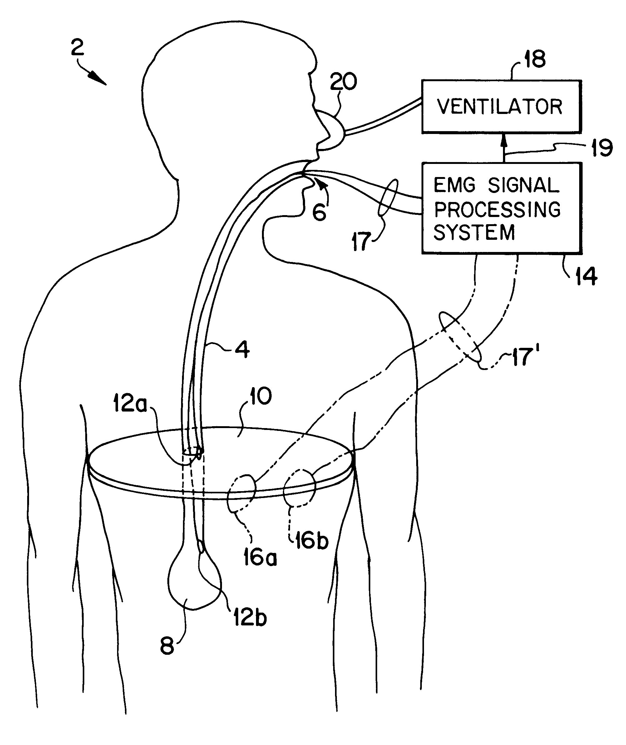 Method and apparatus for producing a model EMG signal from a measured EMG signal