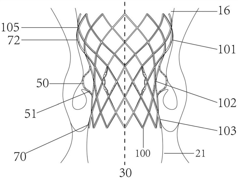 A structure-fit transcatheter aortic valve implantation device