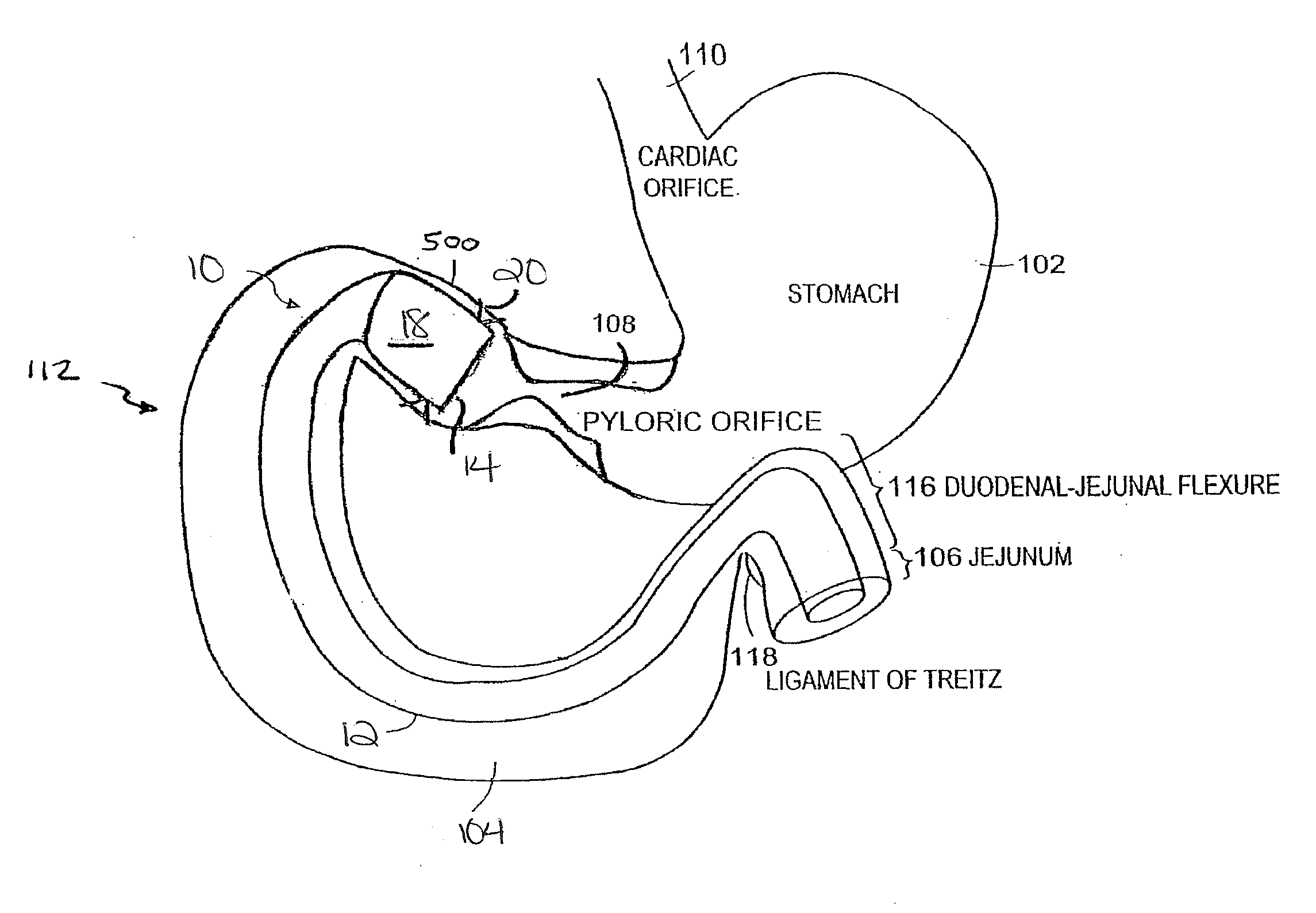Method for gastric volume reduction surgery