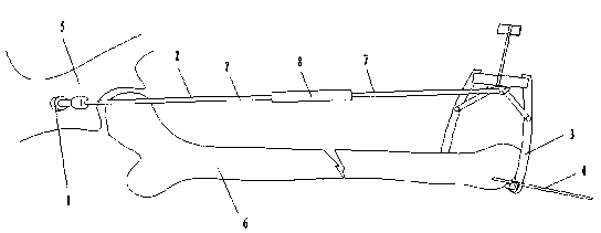 Femoral fracture traction apparatus with good reduction fixing effect