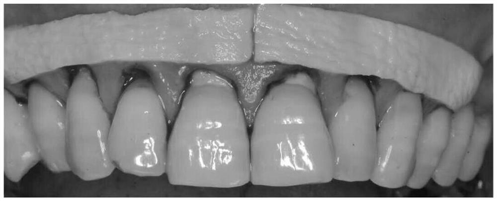 A kind of acellular allogeneic dermal matrix and its application in oral diseases