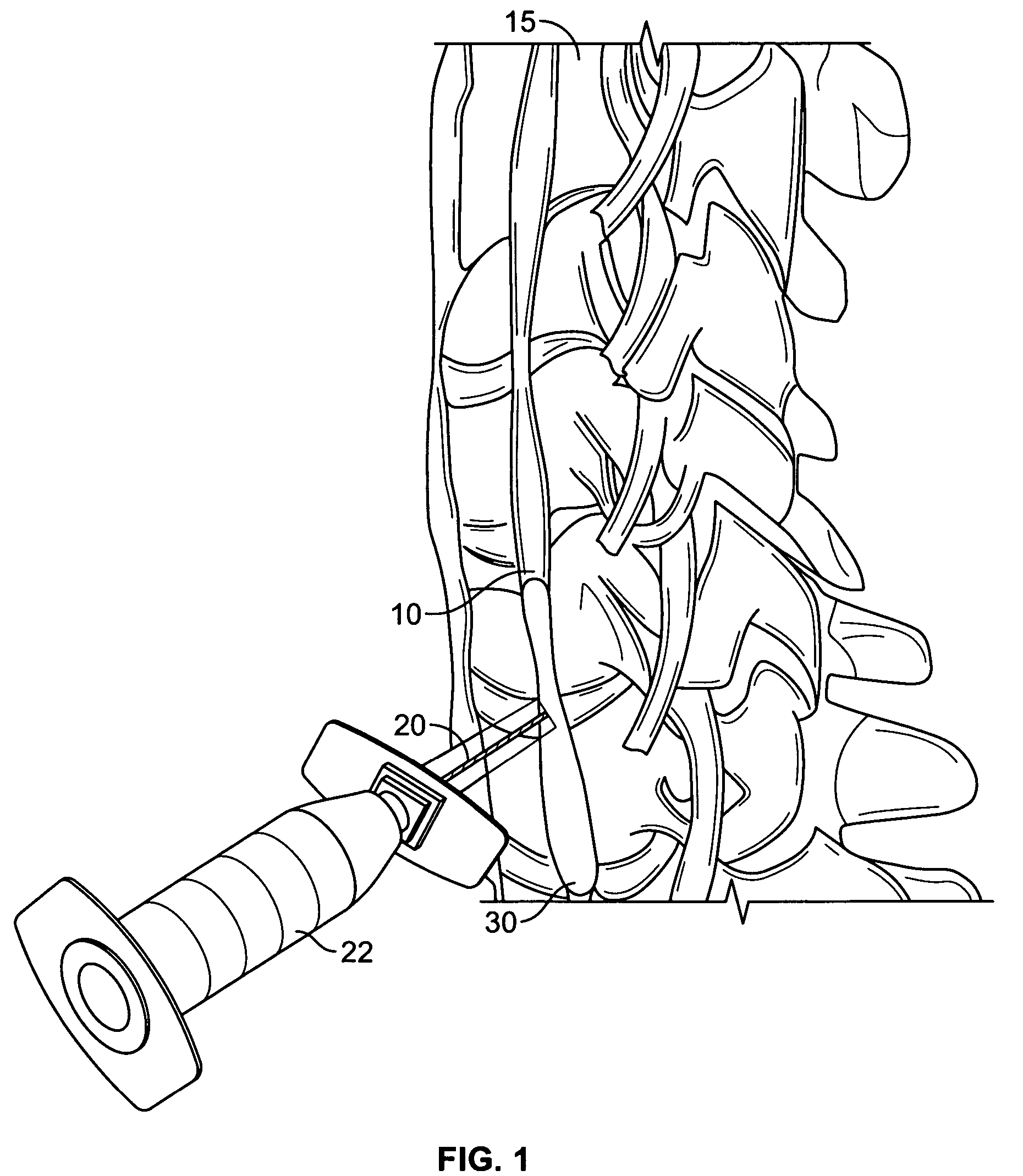 Use of stellate ganglion block for the treatment of post partum depression