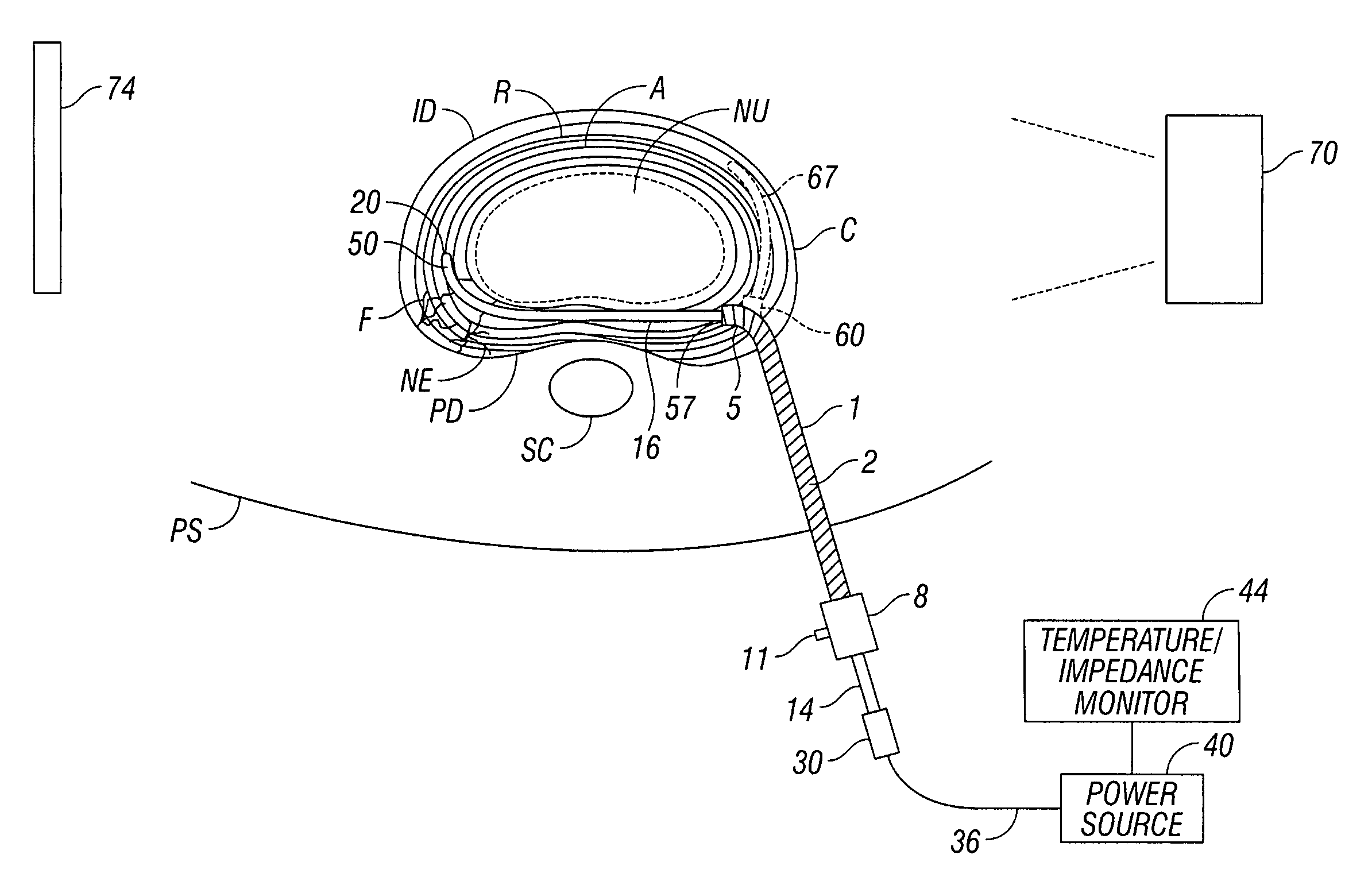 Apparatus for thermal treatment of an intervertebral disc