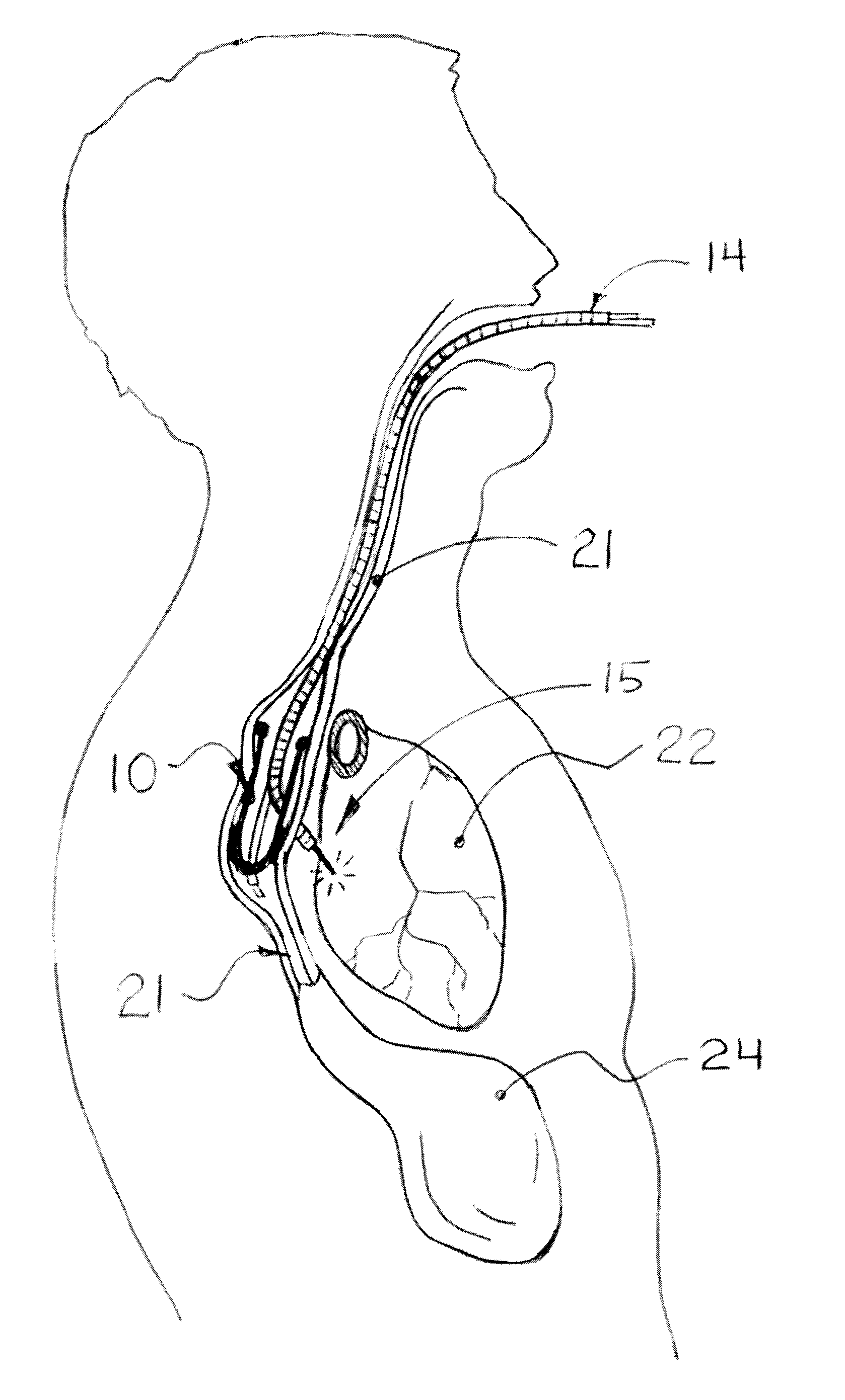 Methods and apparatus for transesophageal microaccess surgery