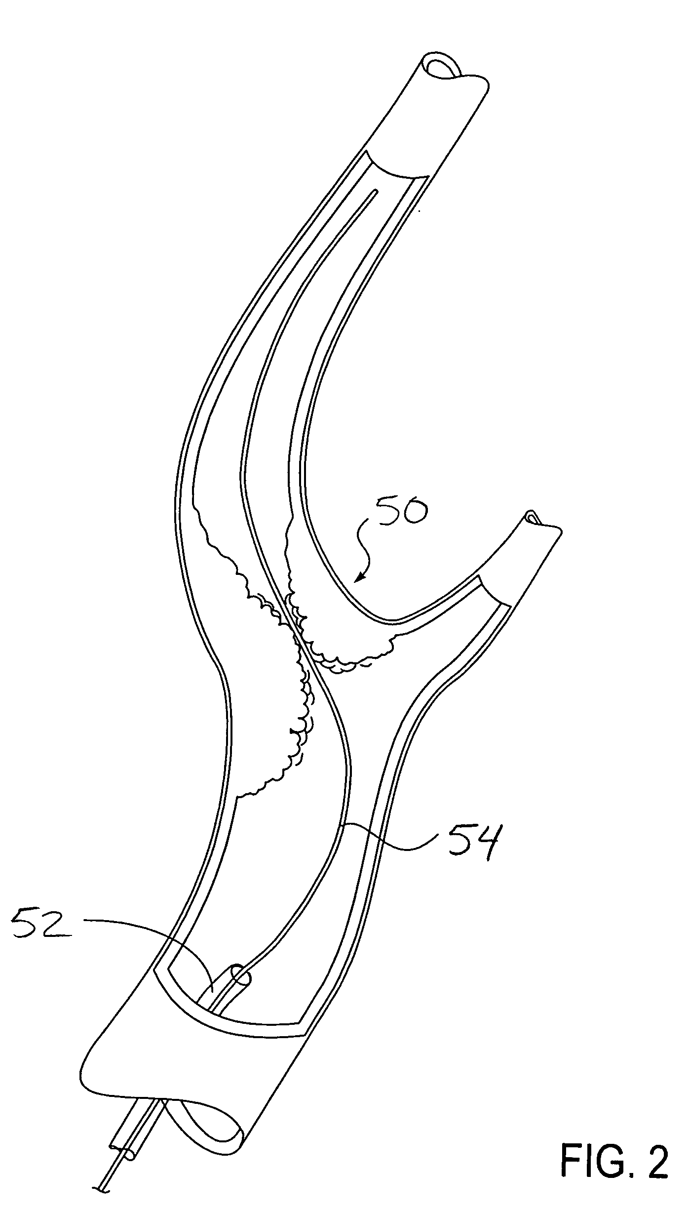Catheter system for protected angioplasty and stenting at a carotid bifurcation