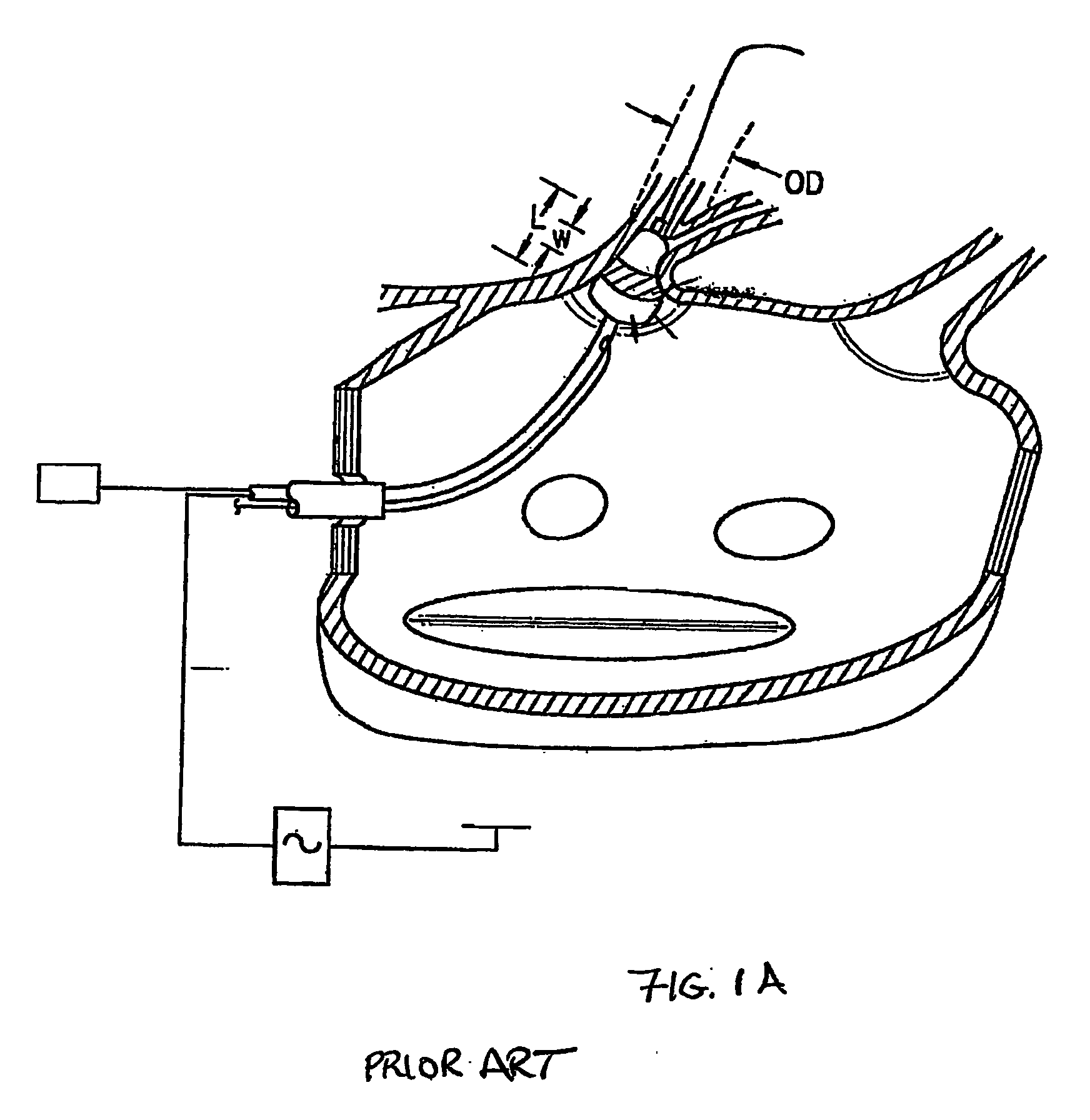 Catheter and Method for Ablation of Atrial Tissue