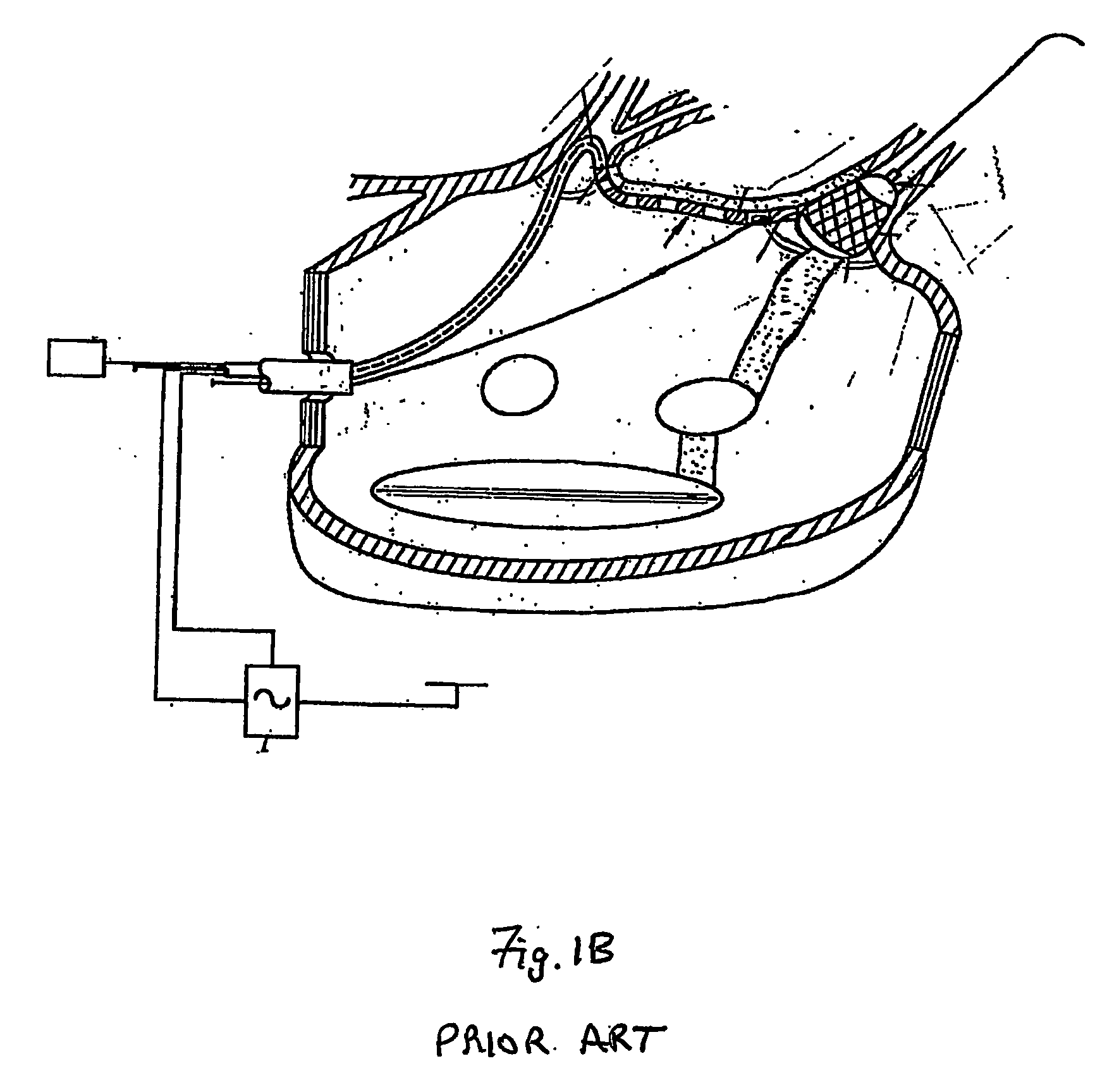 Catheter and Method for Ablation of Atrial Tissue