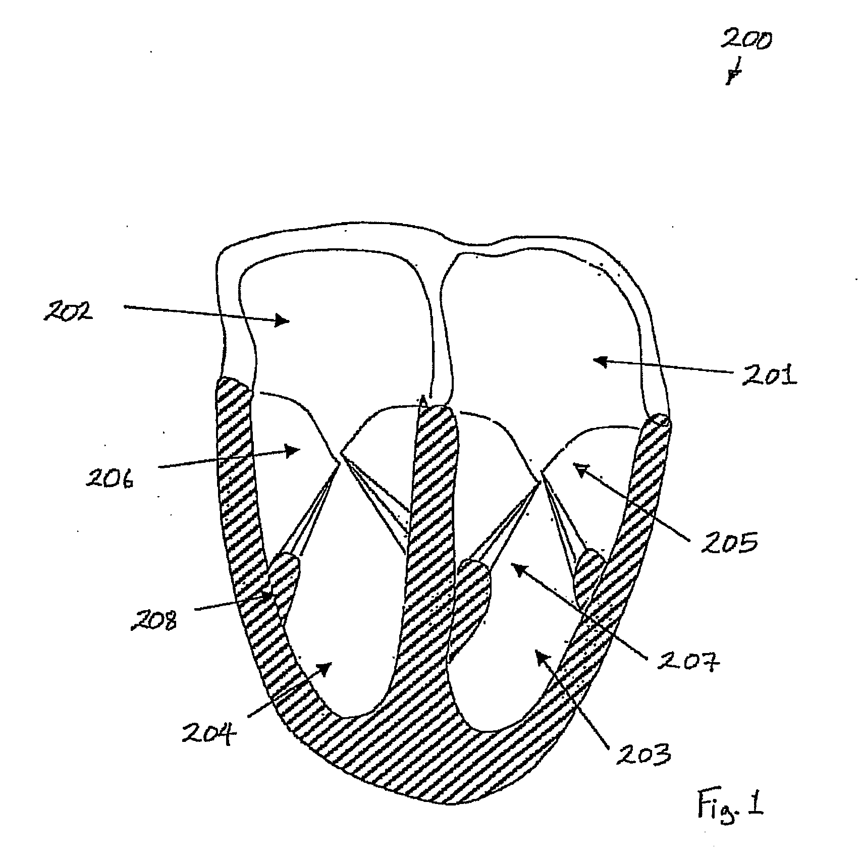 Medical device suitable for use in treatment of a valve