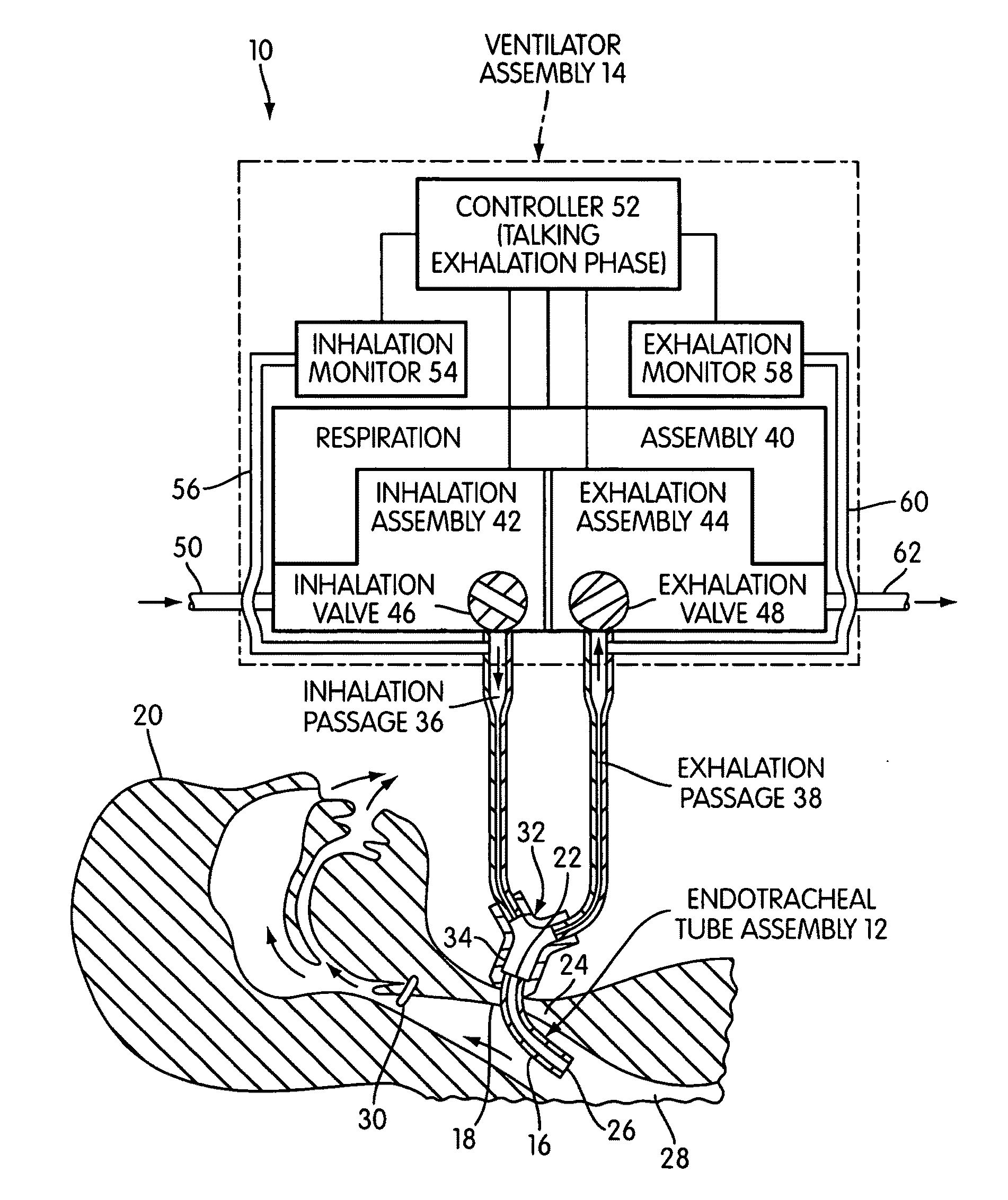 Ventilating apparatus and method enabling a patient to talk with or without a trachostomy tube check valve
