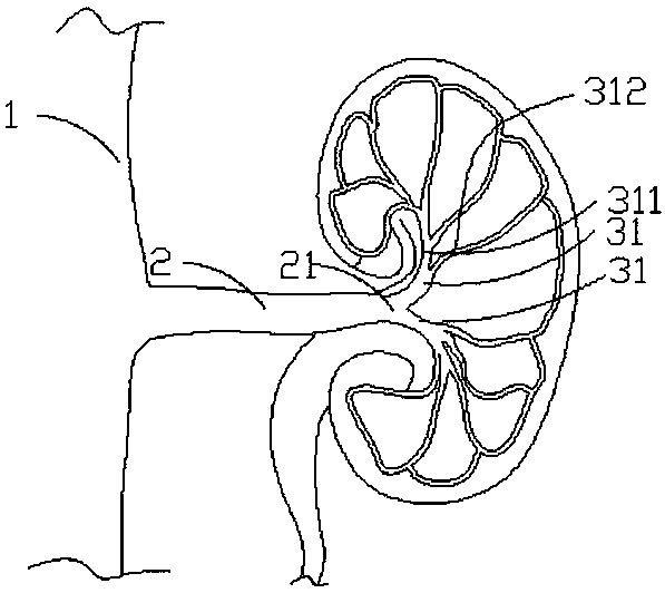 Ablation catheter