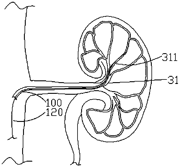 Ablation catheter