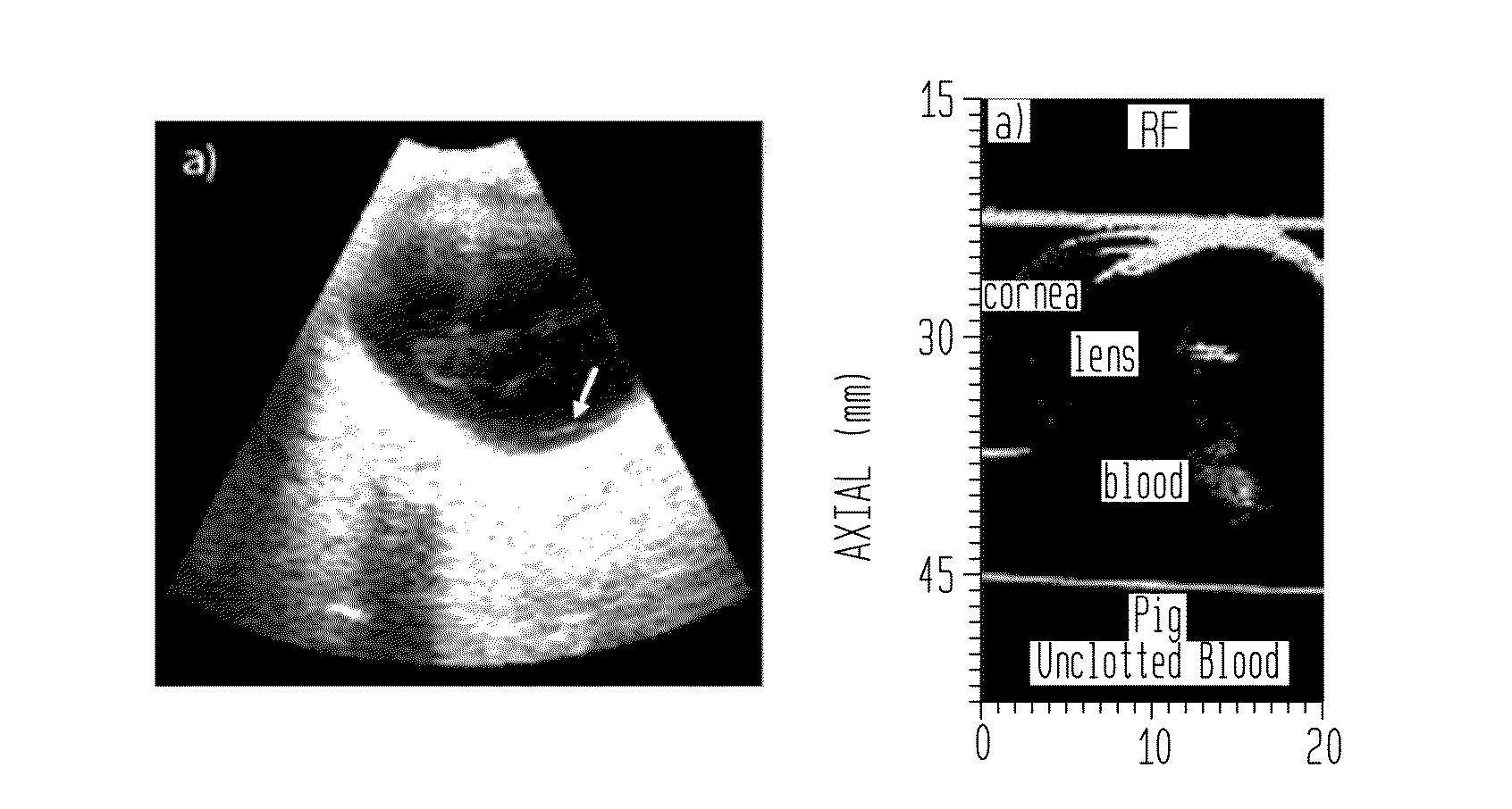 Methods for diagnosing vitreo-retinal disease