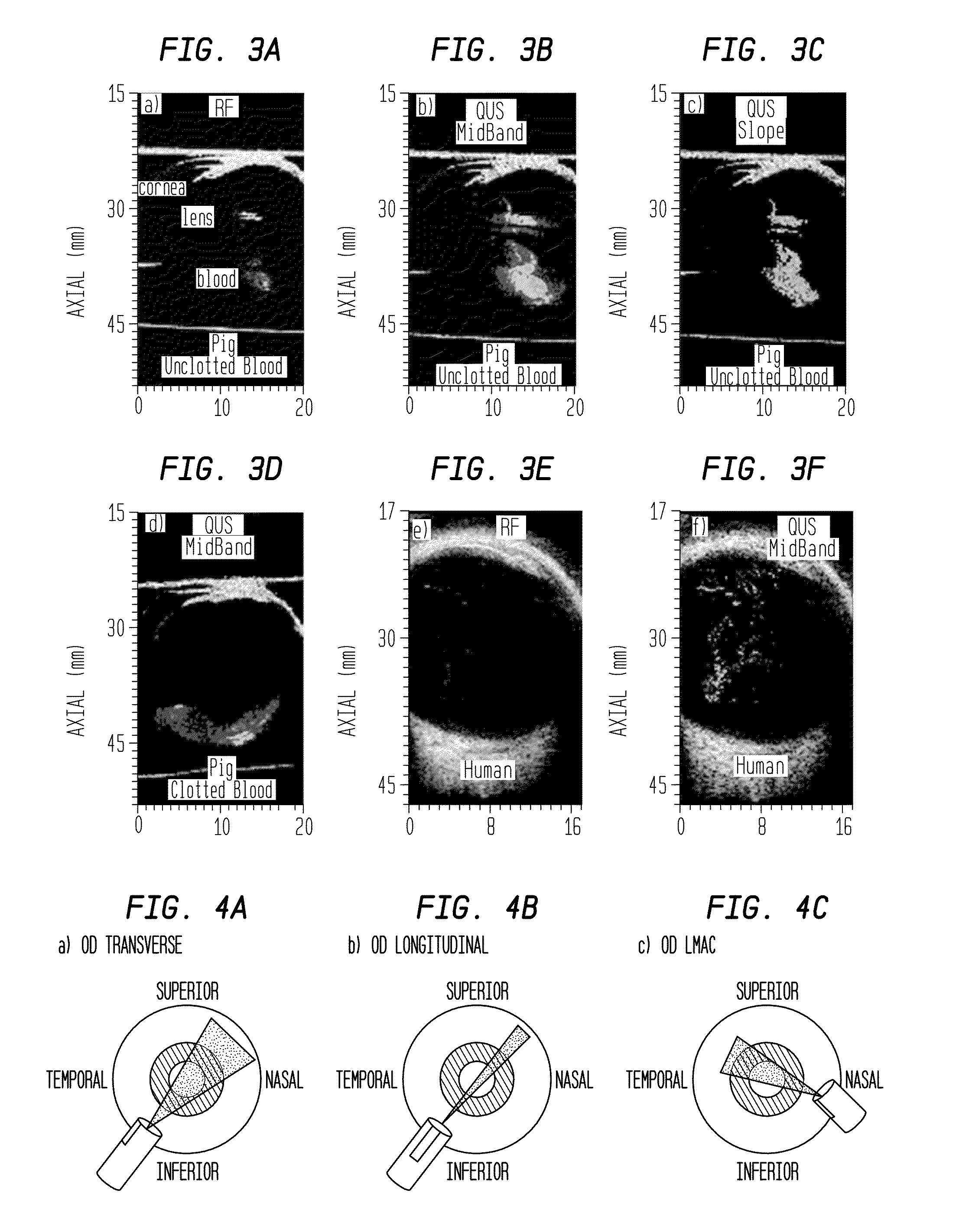 Methods for diagnosing vitreo-retinal disease