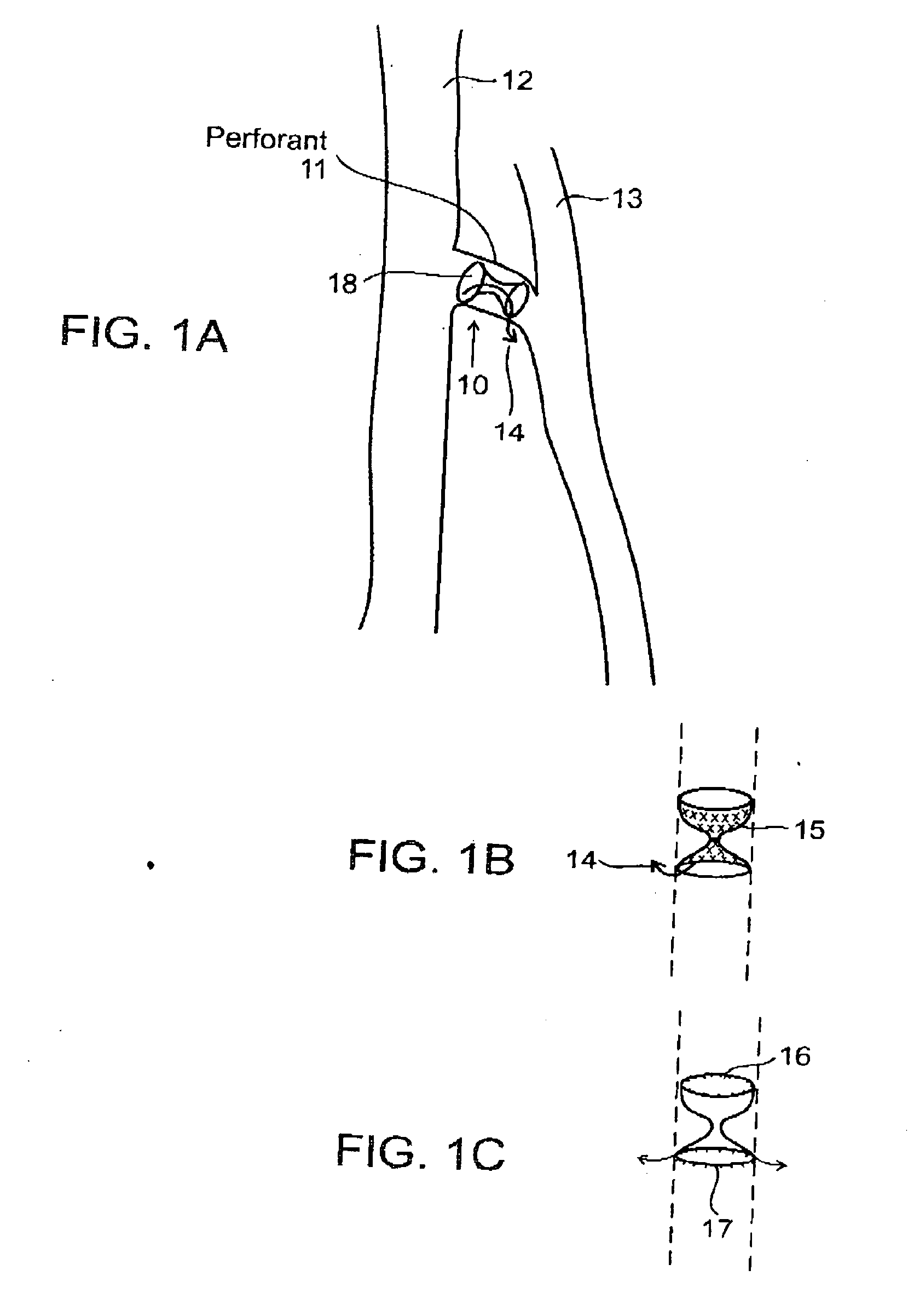 Apparatus and method for enabling perforating vein ablation