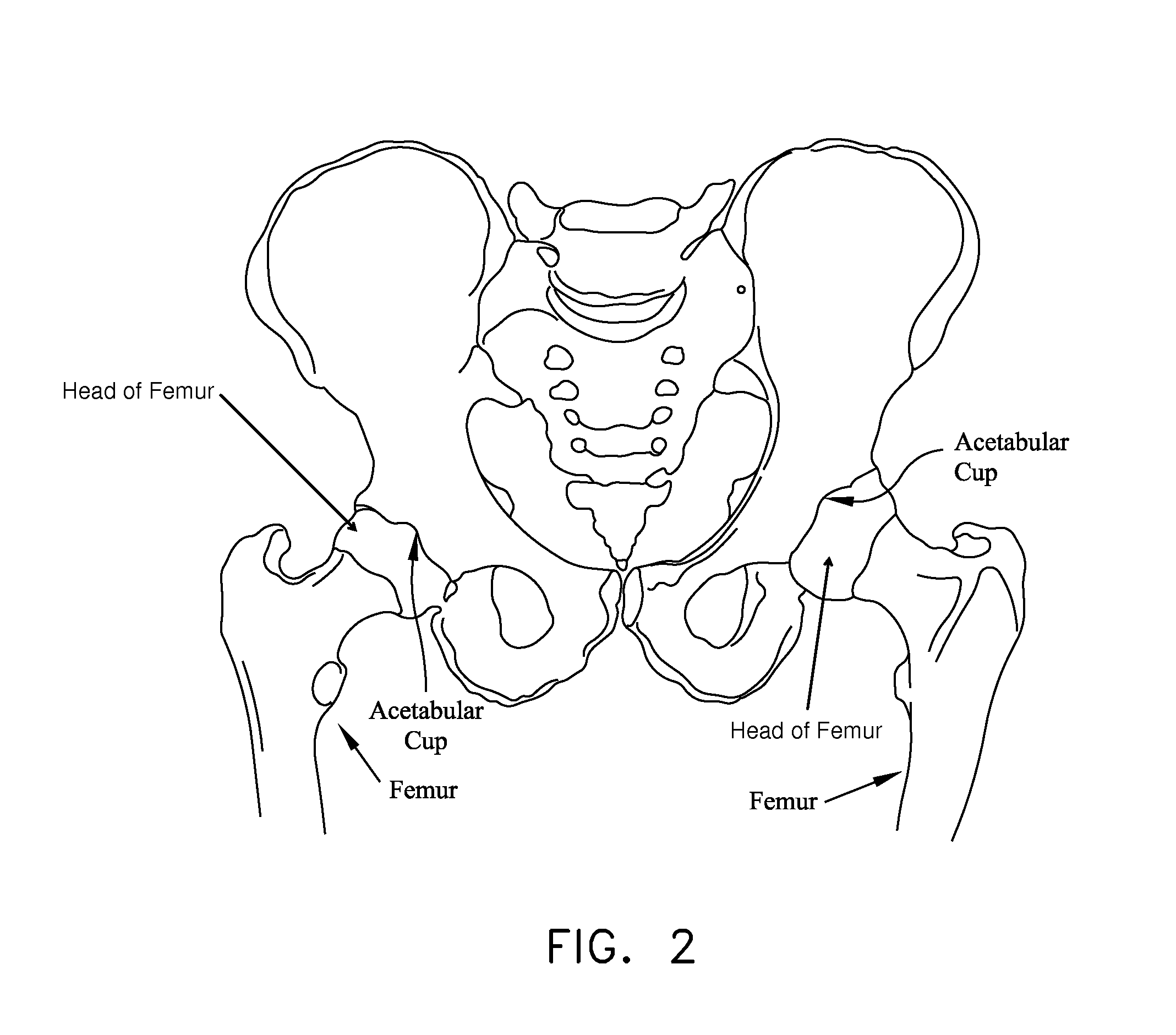 Method and apparatus for attaching tissue to bone, including the provision and use of a novel knotless suture anchor system, including a novel locking element