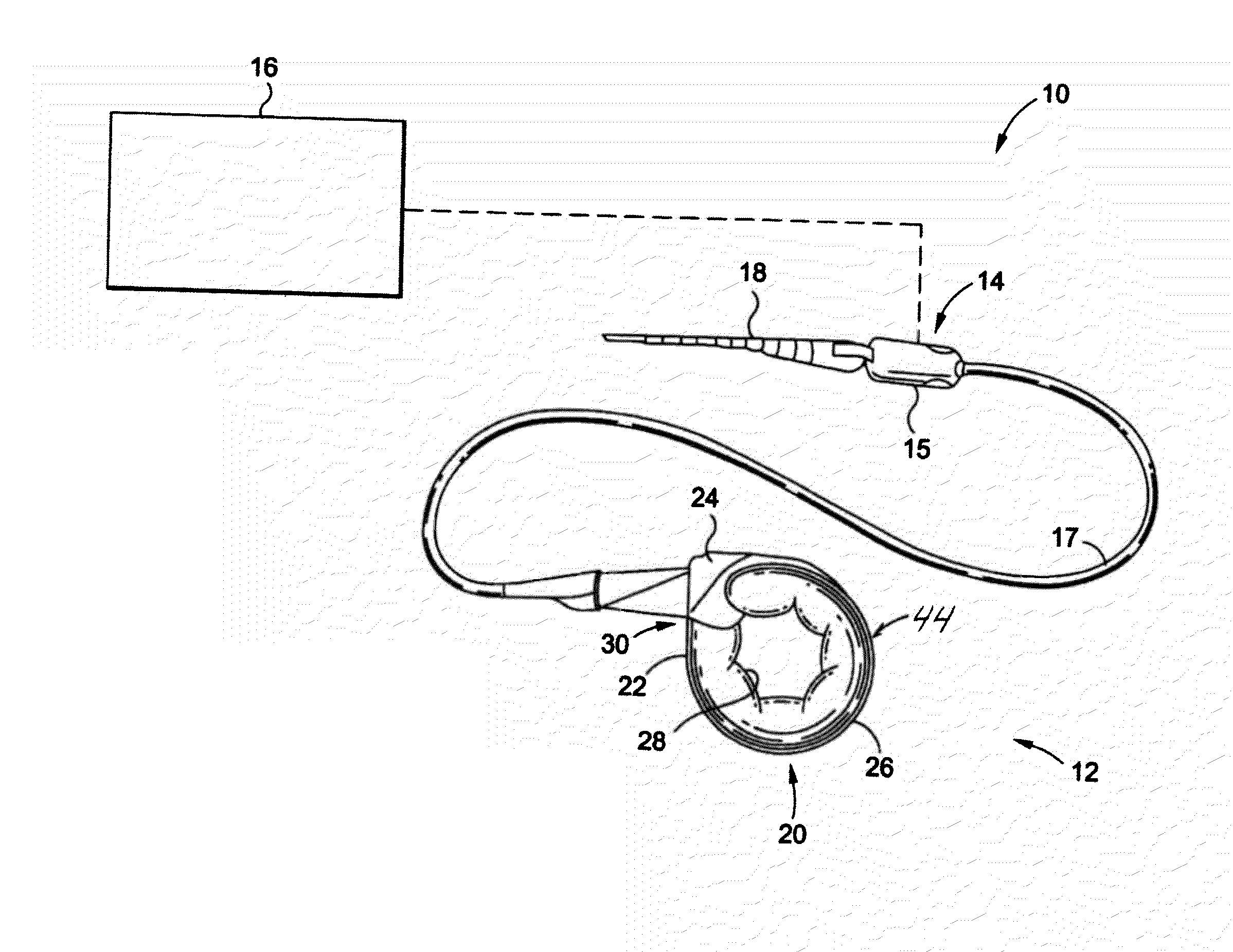 Mechanical Gastric Band With Cushions