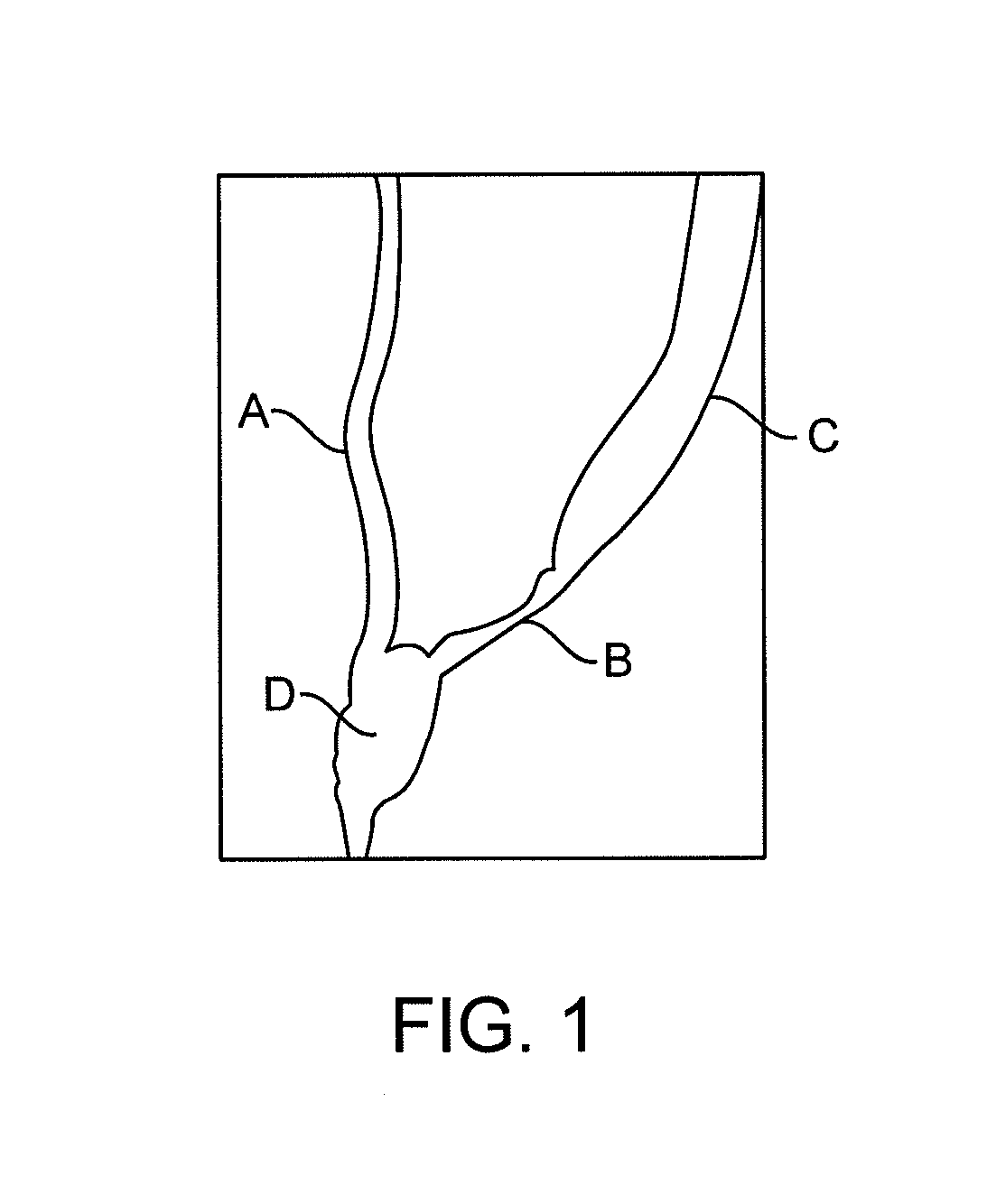 Stent to assist in arteriovenous fistula formation