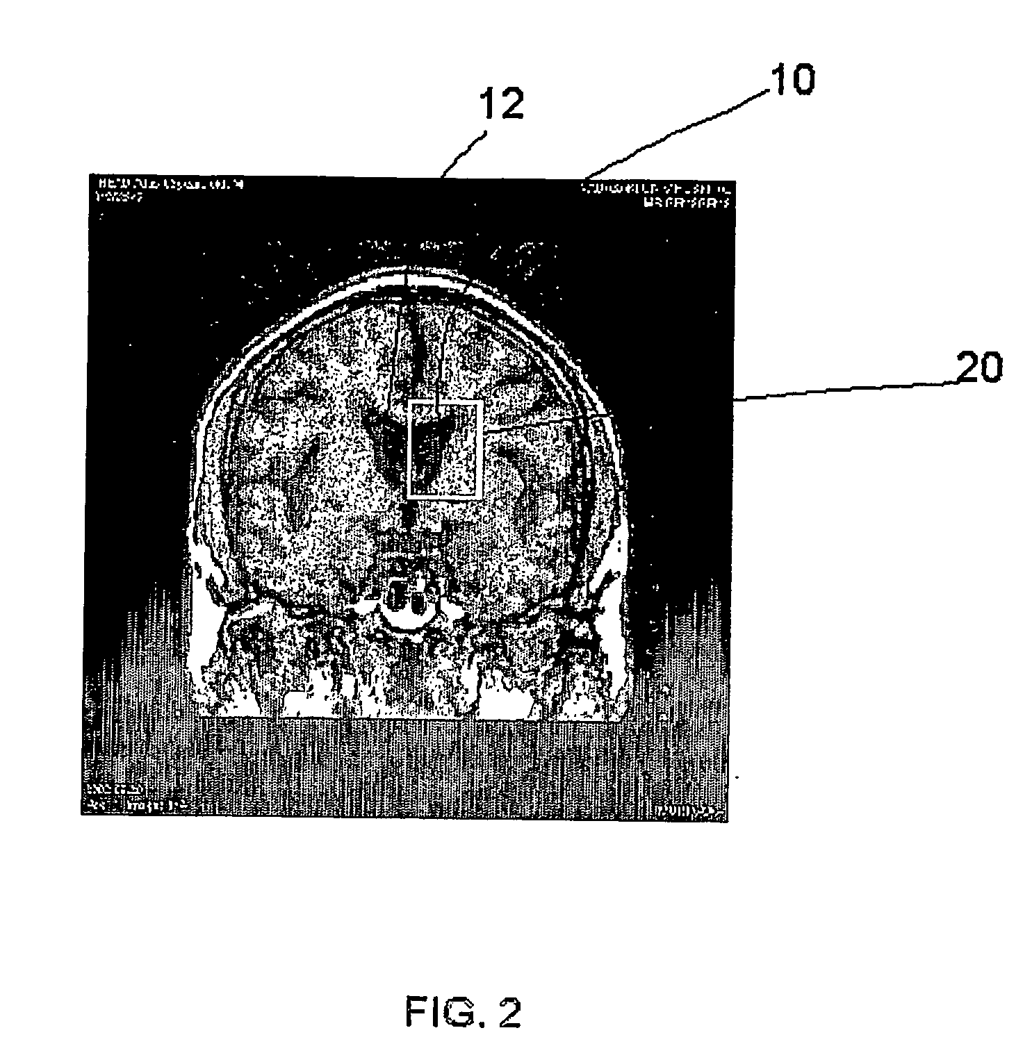 Method and apparatus for extracting cerebral ventricular system from images