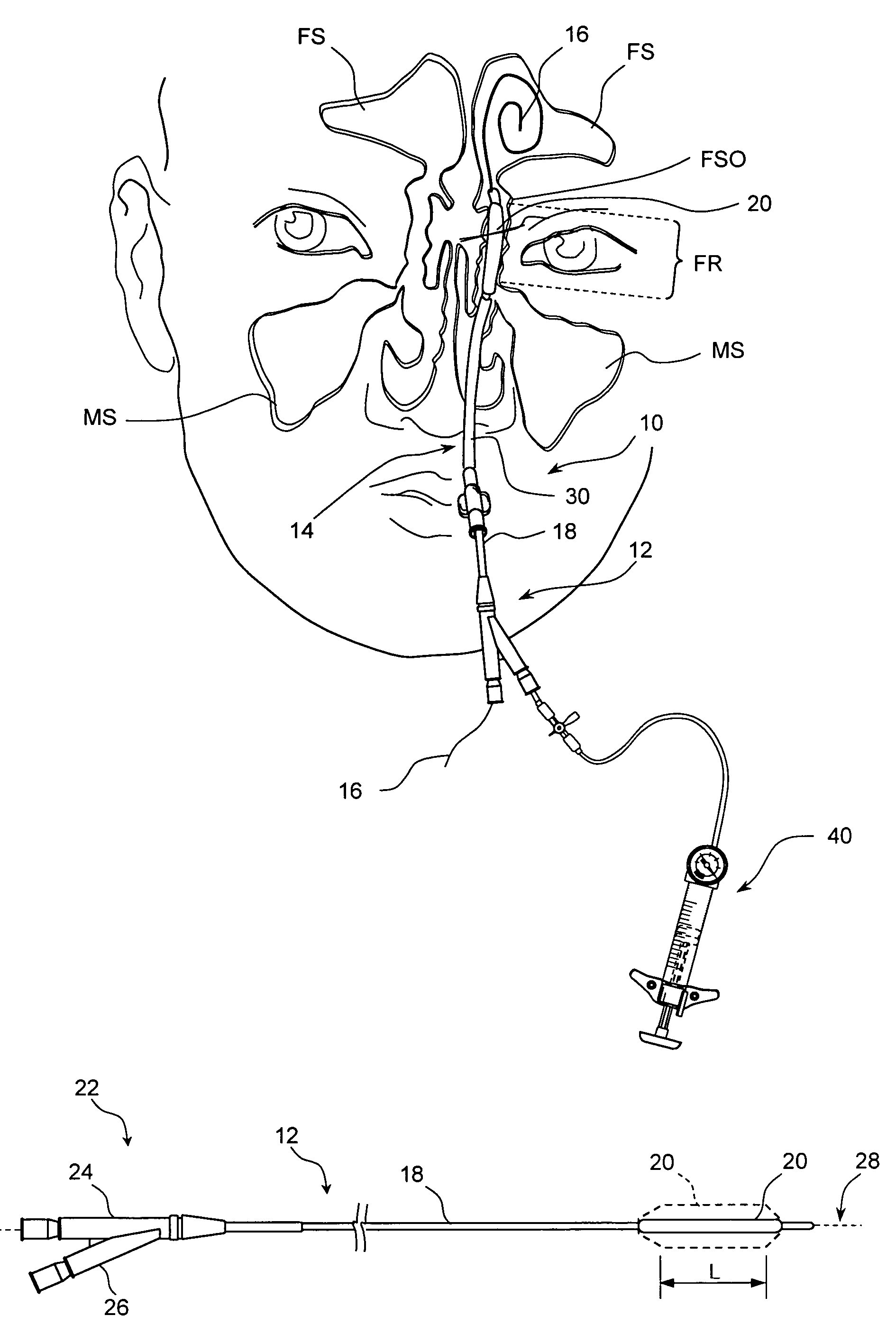 Devices, systems and methods useable for treating frontal sinusitis