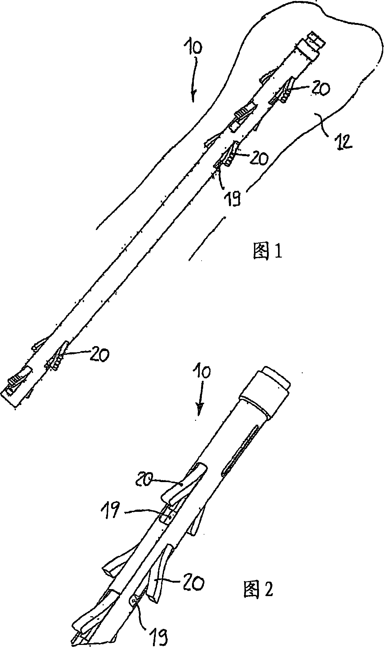 Intramedullary nail provided with shape memory material elements