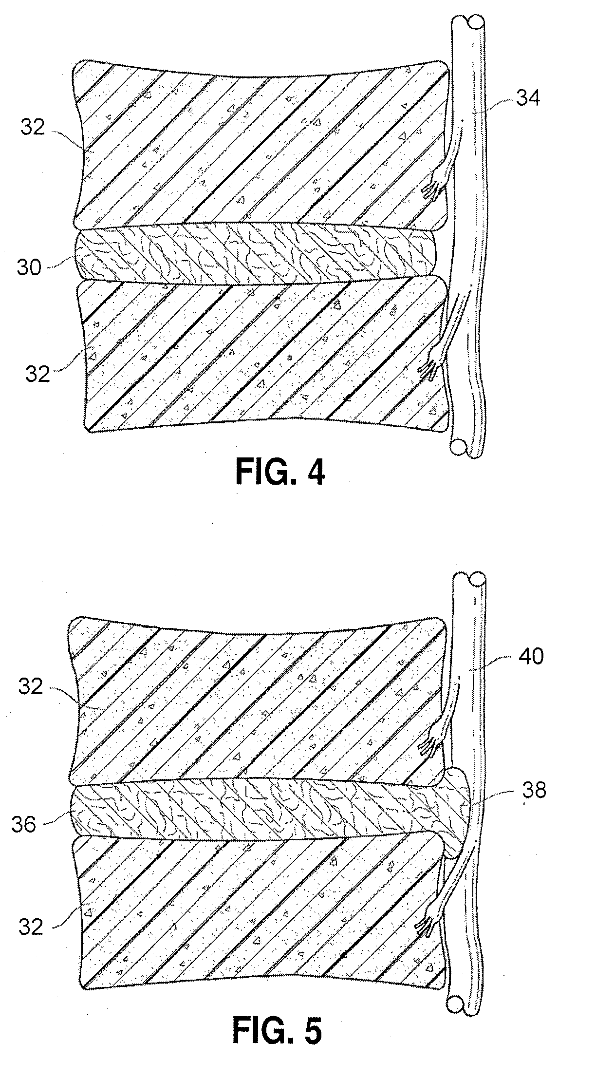 Spinal implants and methods