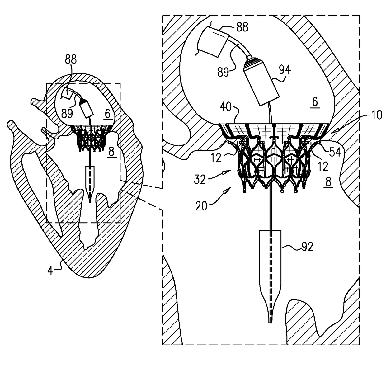 Prosthetic Heart Valve with Compressible Frames