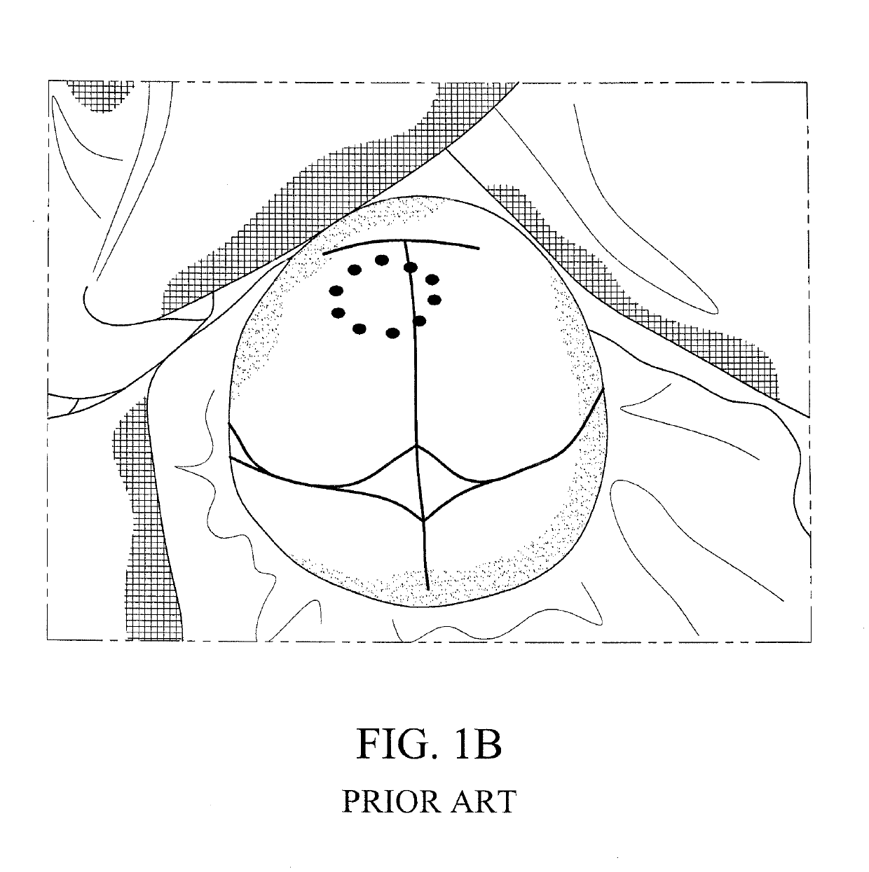 Method for performing single-stage cranioplasty reconstruction with a clear custom craniofacial implant
