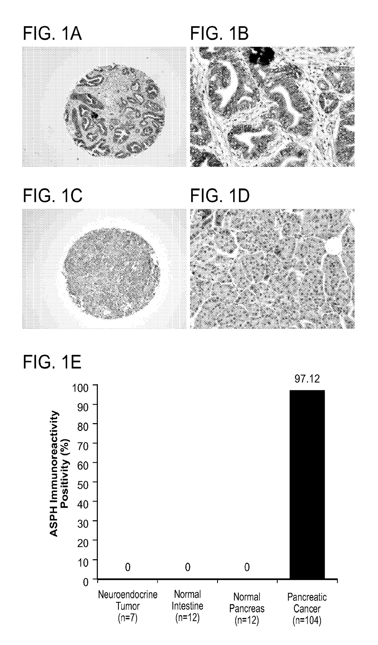 Inhibitors of beta-hydroxylase for treatment of cancer