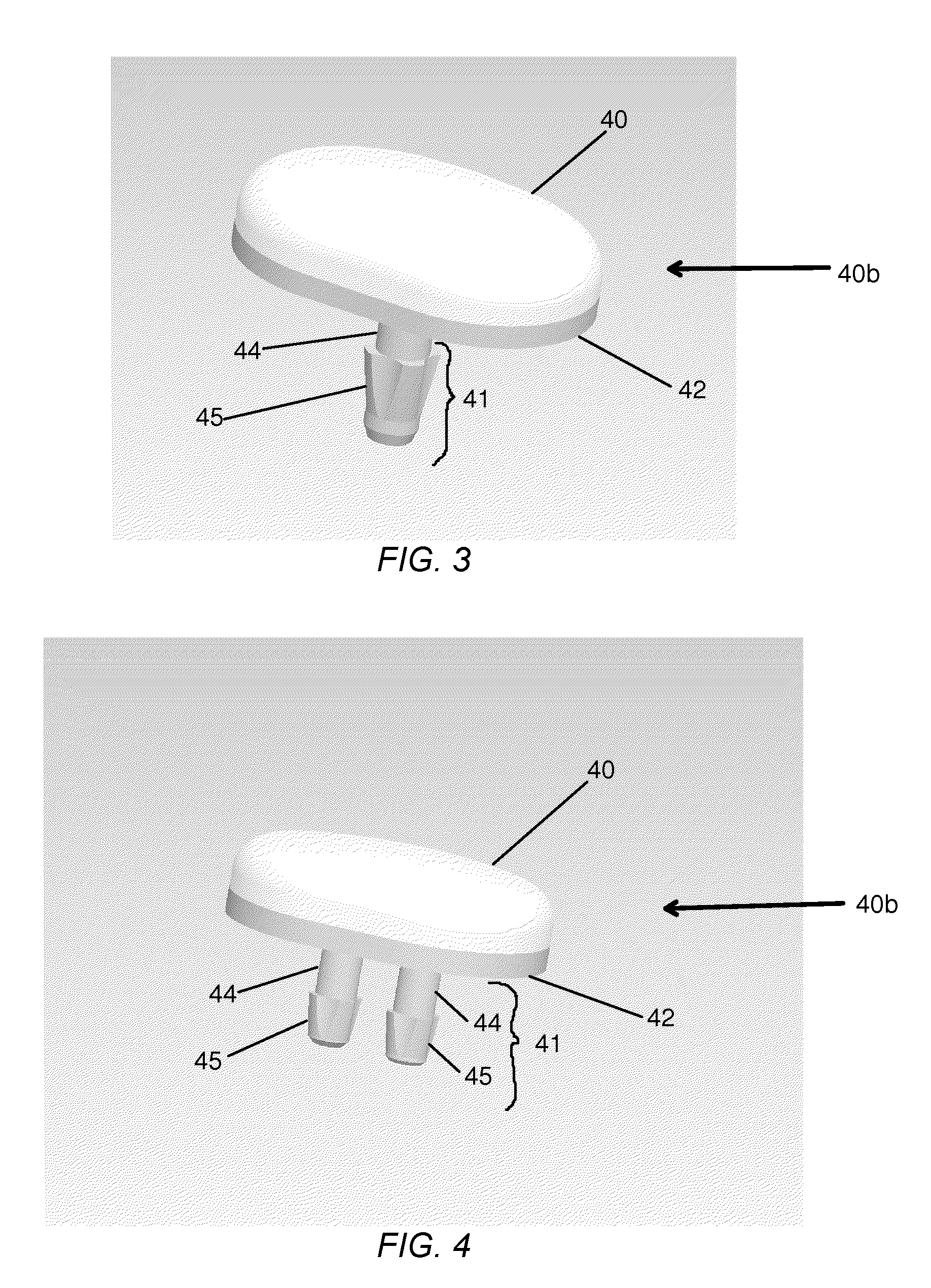 Partial joint resurfacing implant, instrumentation and method