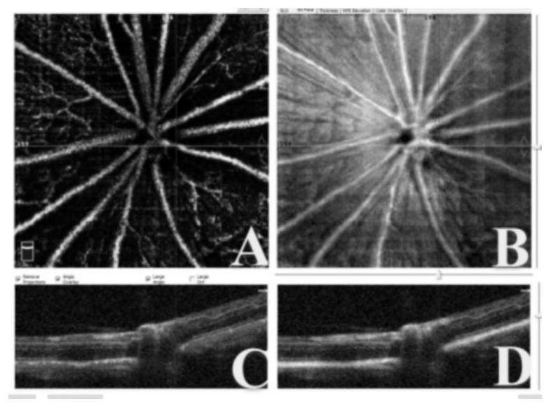 A method for establishing an animal model of retinal edema