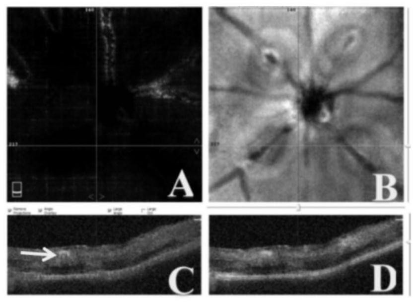 A method for establishing an animal model of retinal edema