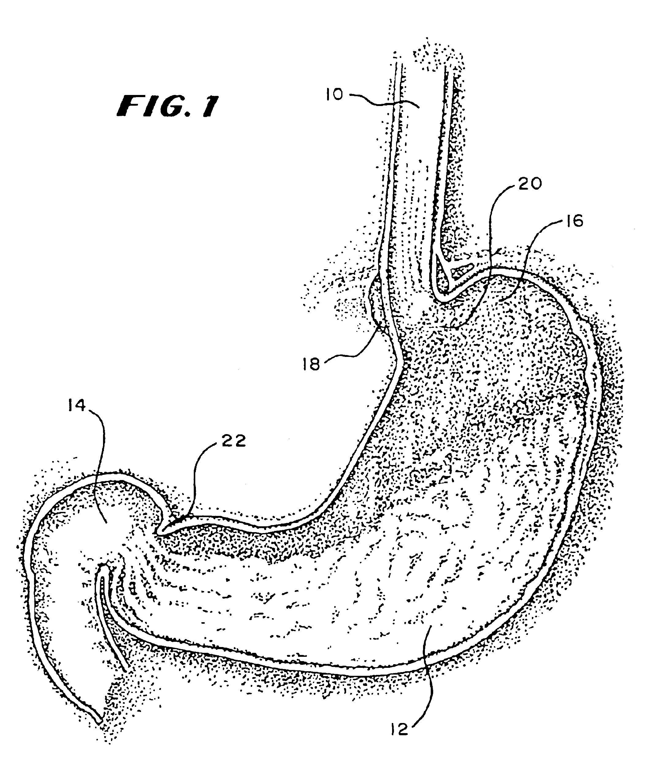Methods for treating the cardia of the stomach