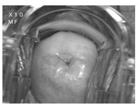 Colposcope-based cervical cancer precancerous lesion detection system and device and medium