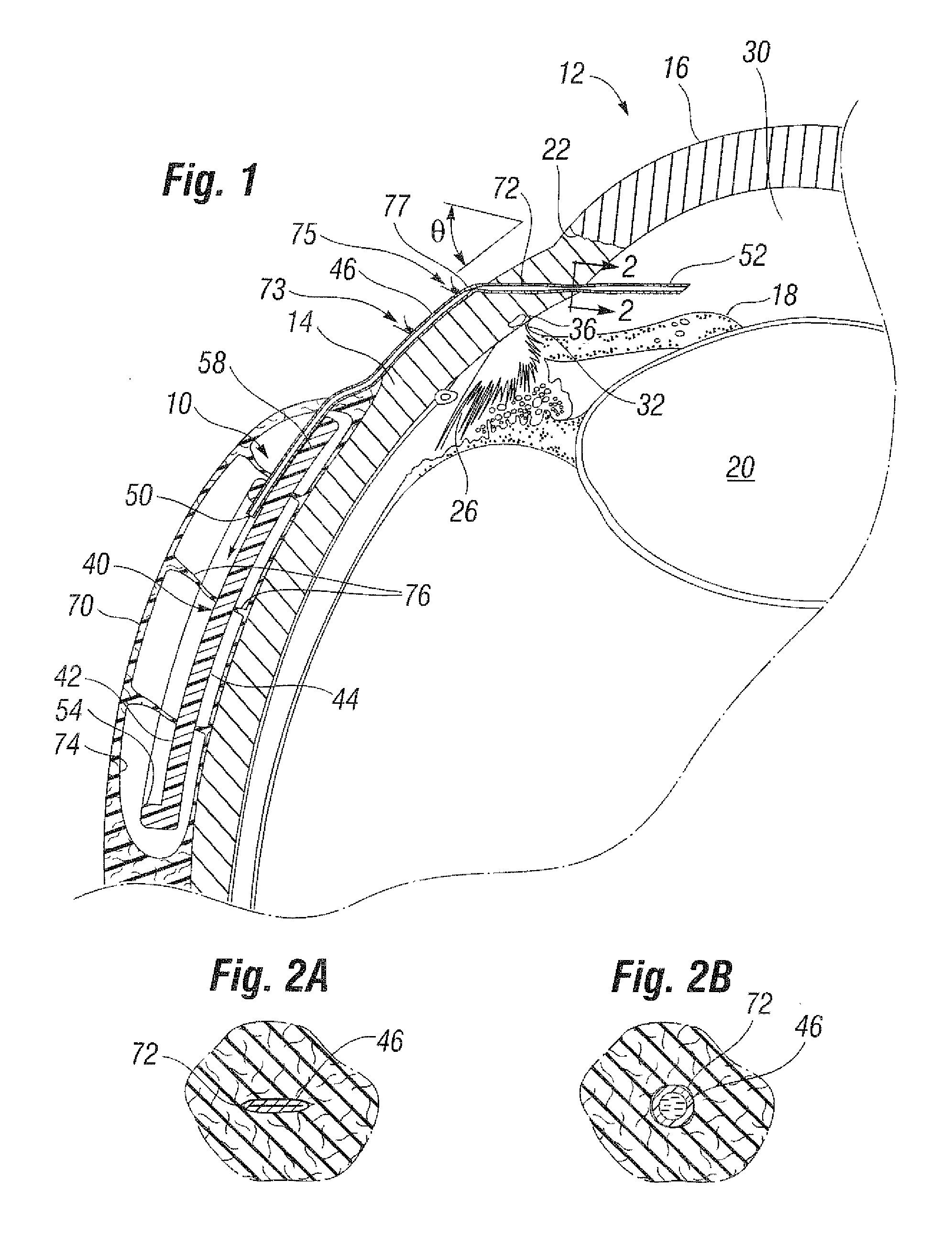 Glaucoma drainage shunts and methods of use