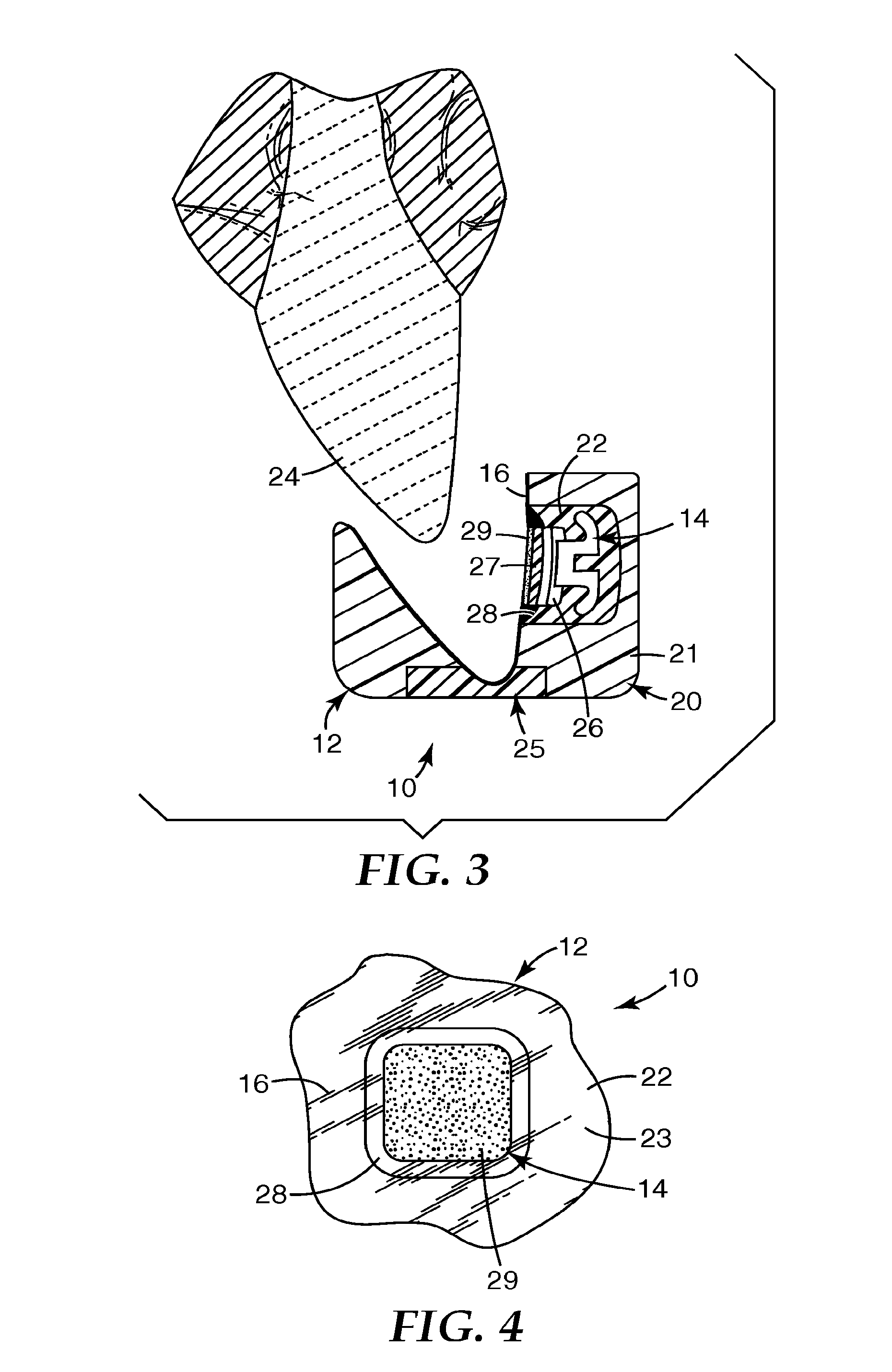 Methods and apparatus for applying dental sealant to an orthodontic patient's teeth