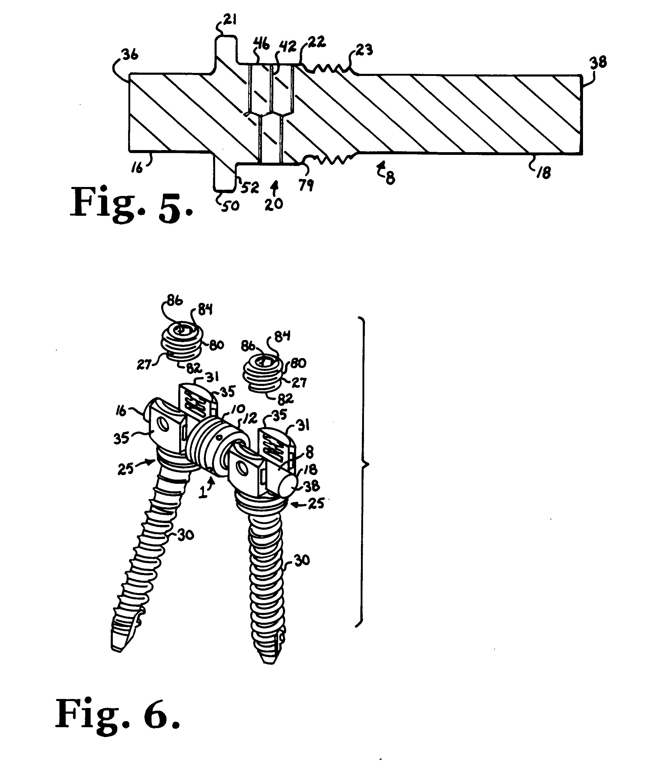 Dynamic stabilization connecting member with slitted segment and surrounding external elastomer