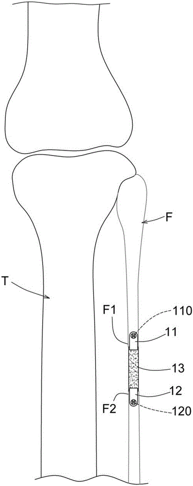Engagement device for preventing bone fusion of fibula truncation part