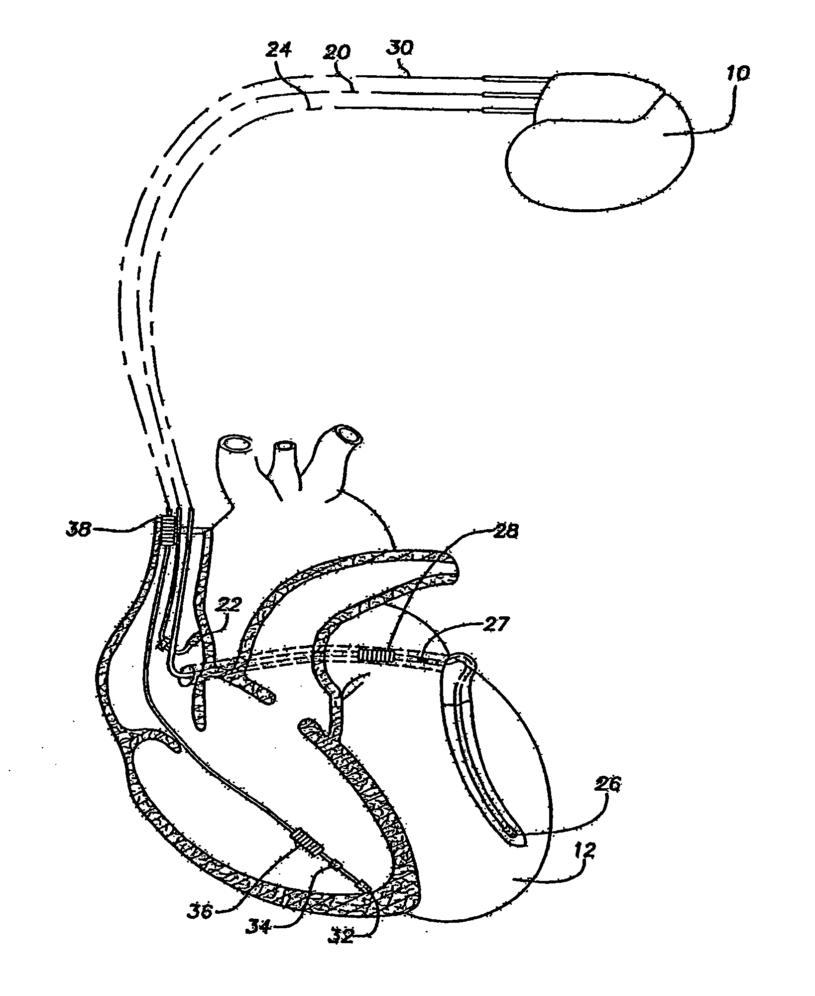 Methods and systems for detecting the presence of T-wave alternans